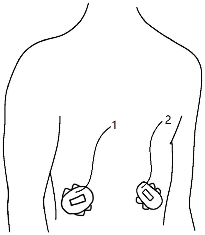 A system and method for closed-loop control of artificial pancreas