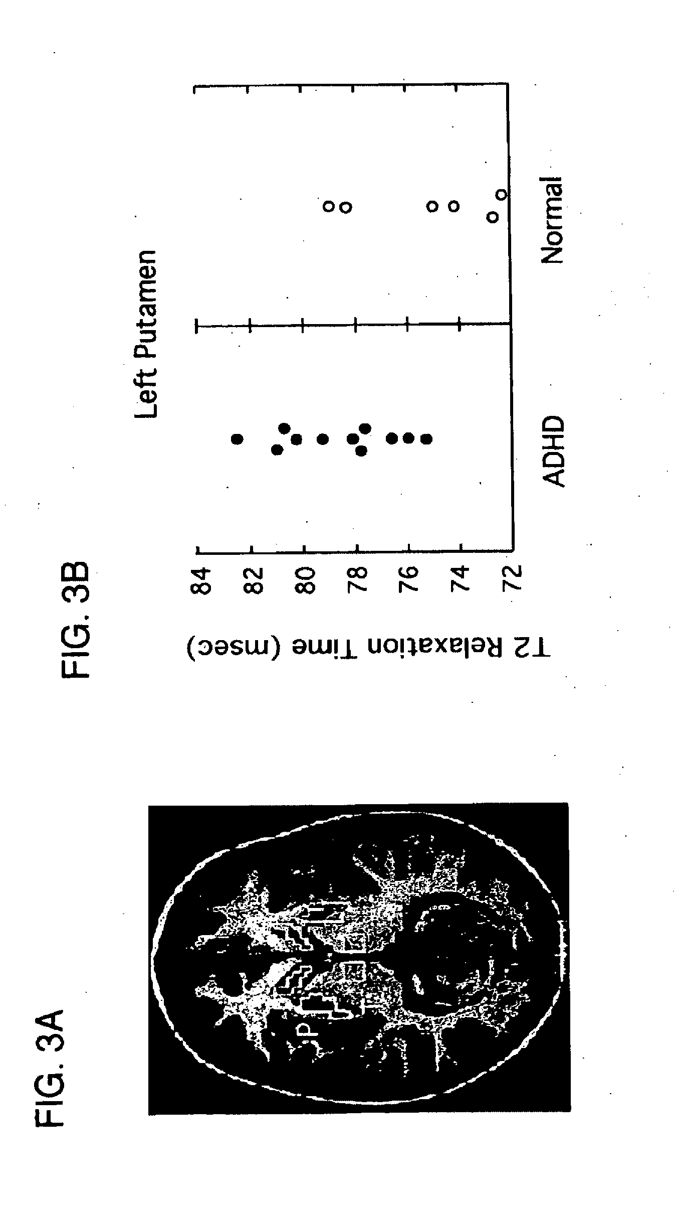 Methods of treating psychiatric, substance abuse, and other disorders using combinations containing omega-3 fatty acids