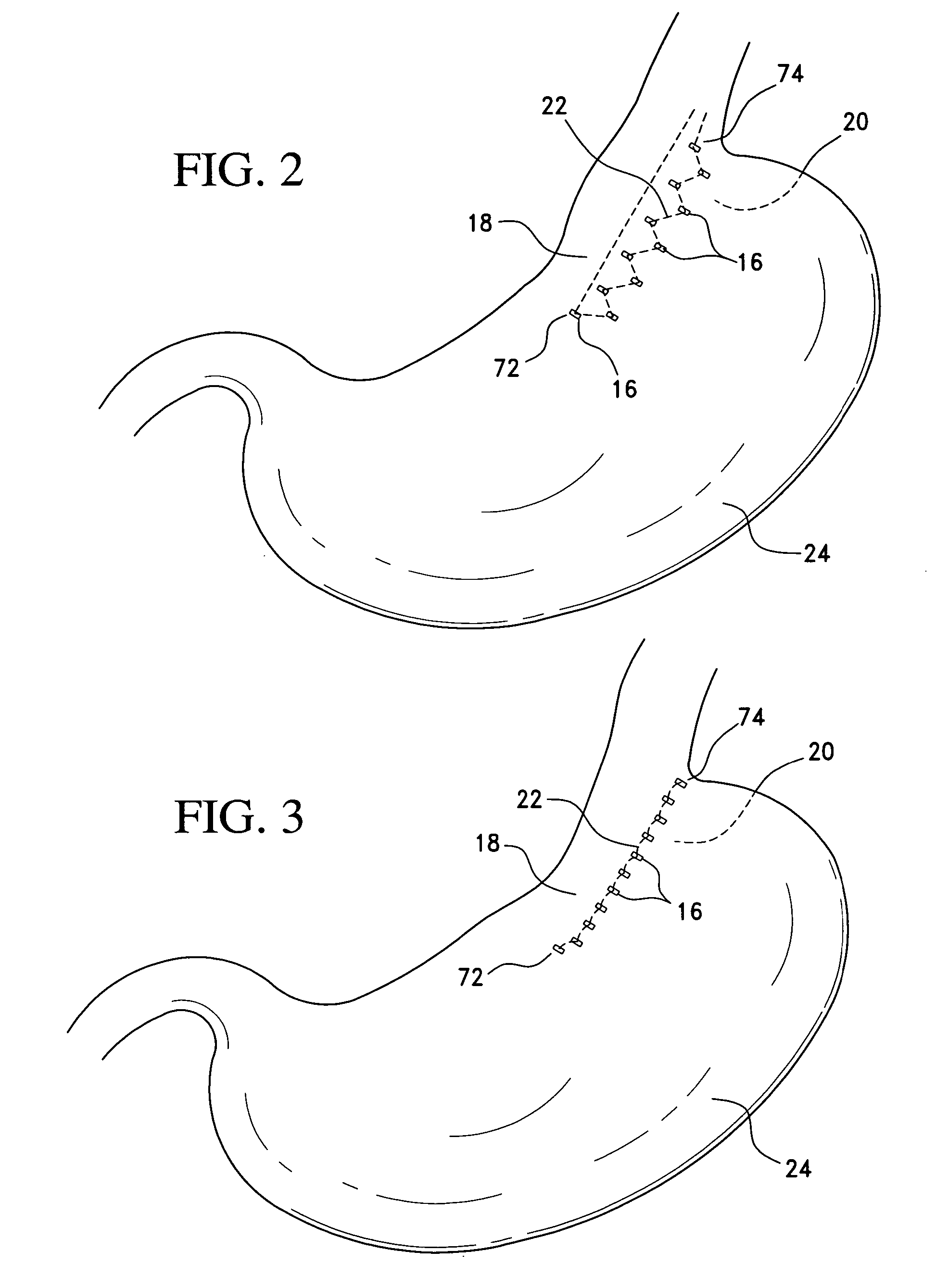 Method and apparatus for endoscopically performing gastric reduction surgery in a single step