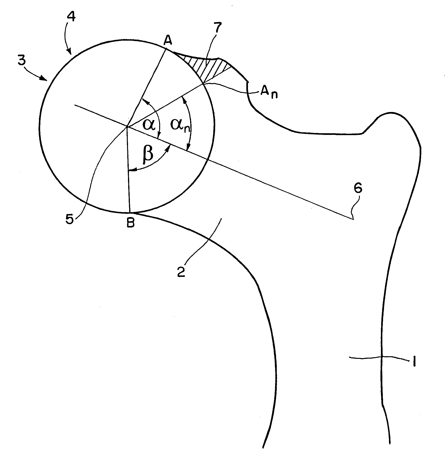 Computer-assisted planning method for correcting changes in the shape of joint bones