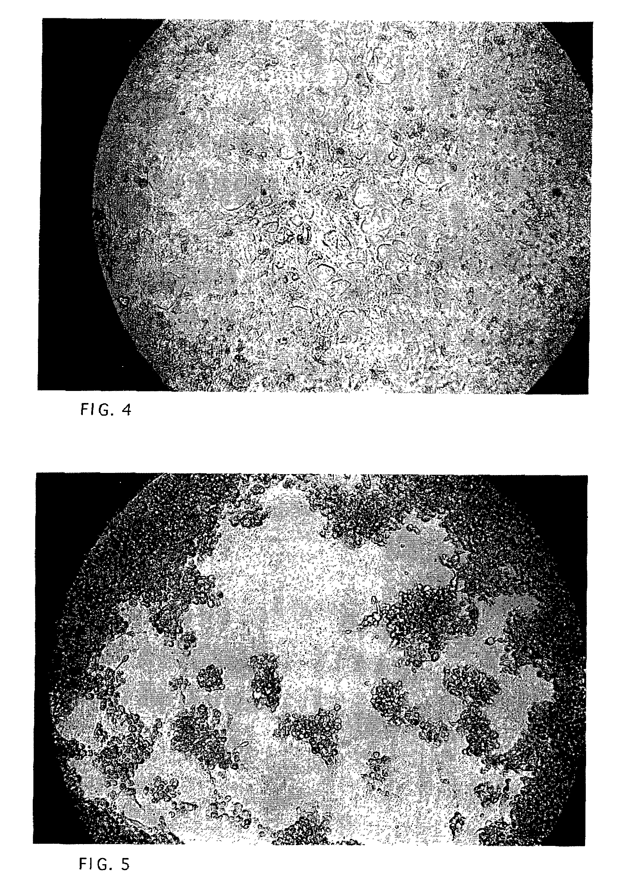Alpha 2HS glycoprotein for treatment of cancer and a method for preparation thereof