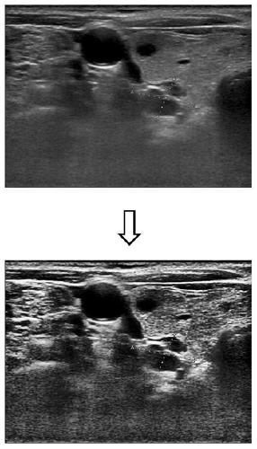 Method for identifying parathyroid hyperplasia in ultrasonic image