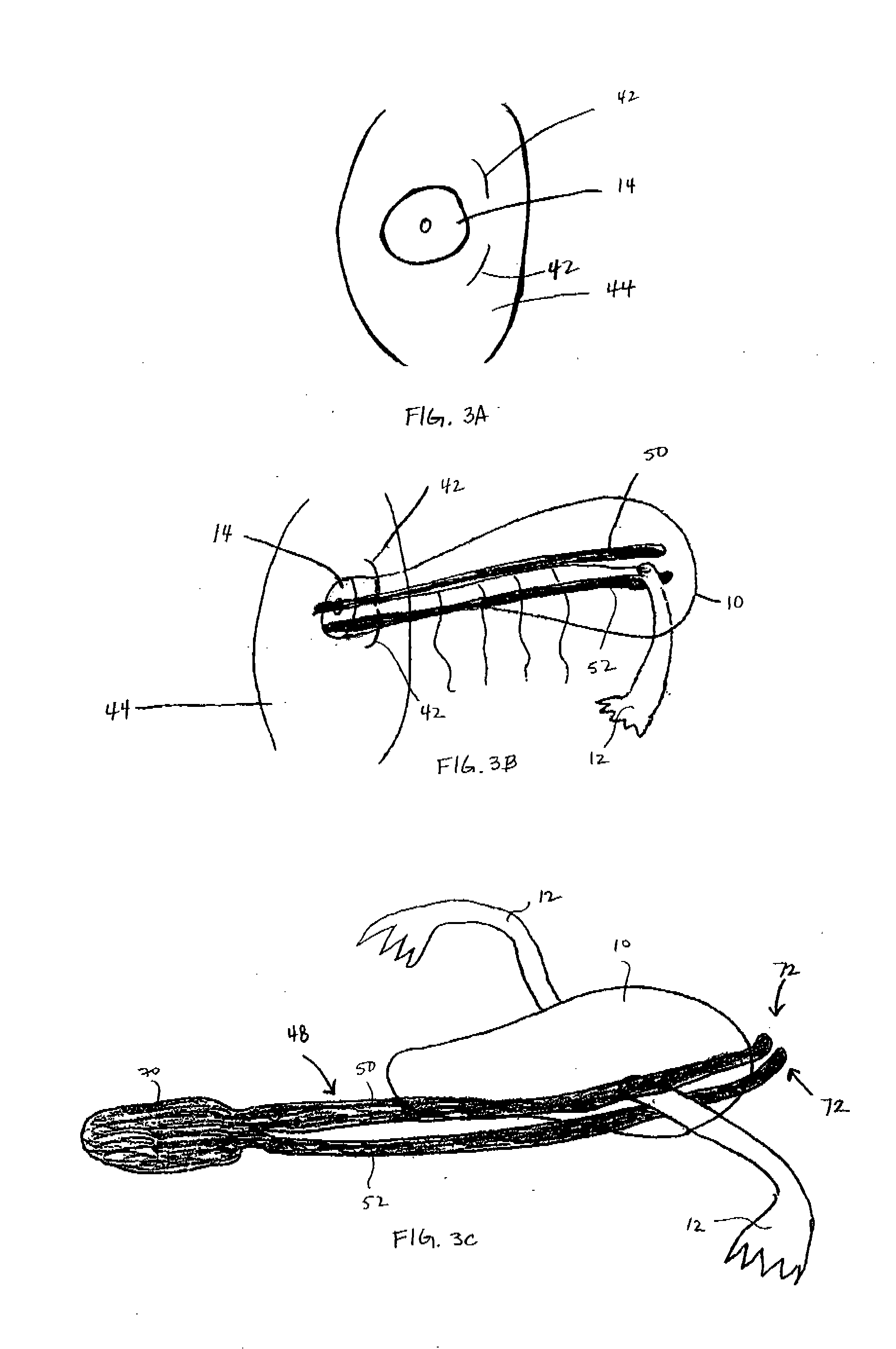 Method and Apparatus for Performing a Surgical Procedure