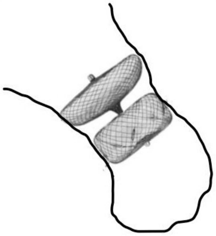 Left atrial appendage occlusion simulation system based on fusion of echocardiography and CT (Computed Tomography) multi-modal image