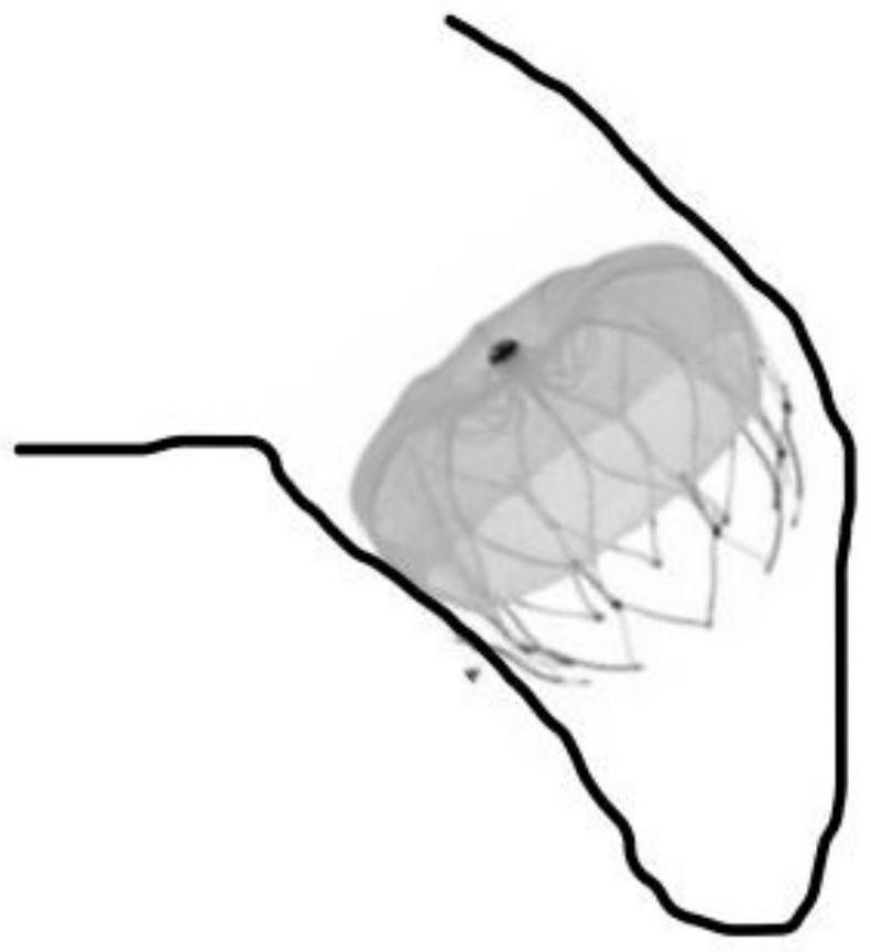 Left atrial appendage occlusion simulation system based on fusion of echocardiography and CT (Computed Tomography) multi-modal image