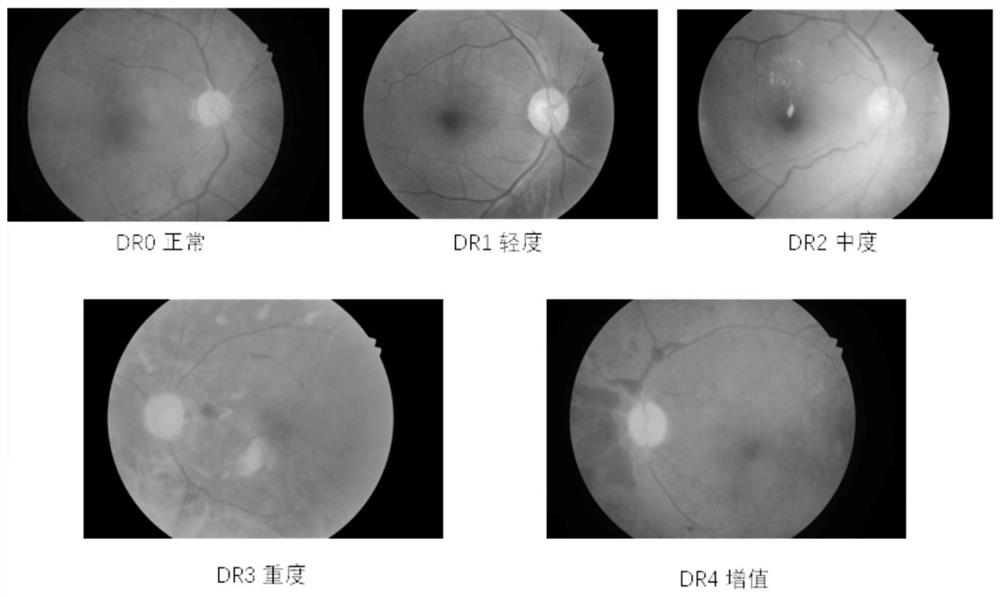 Automatic grading method for diabetic retinopathy image based on label coding