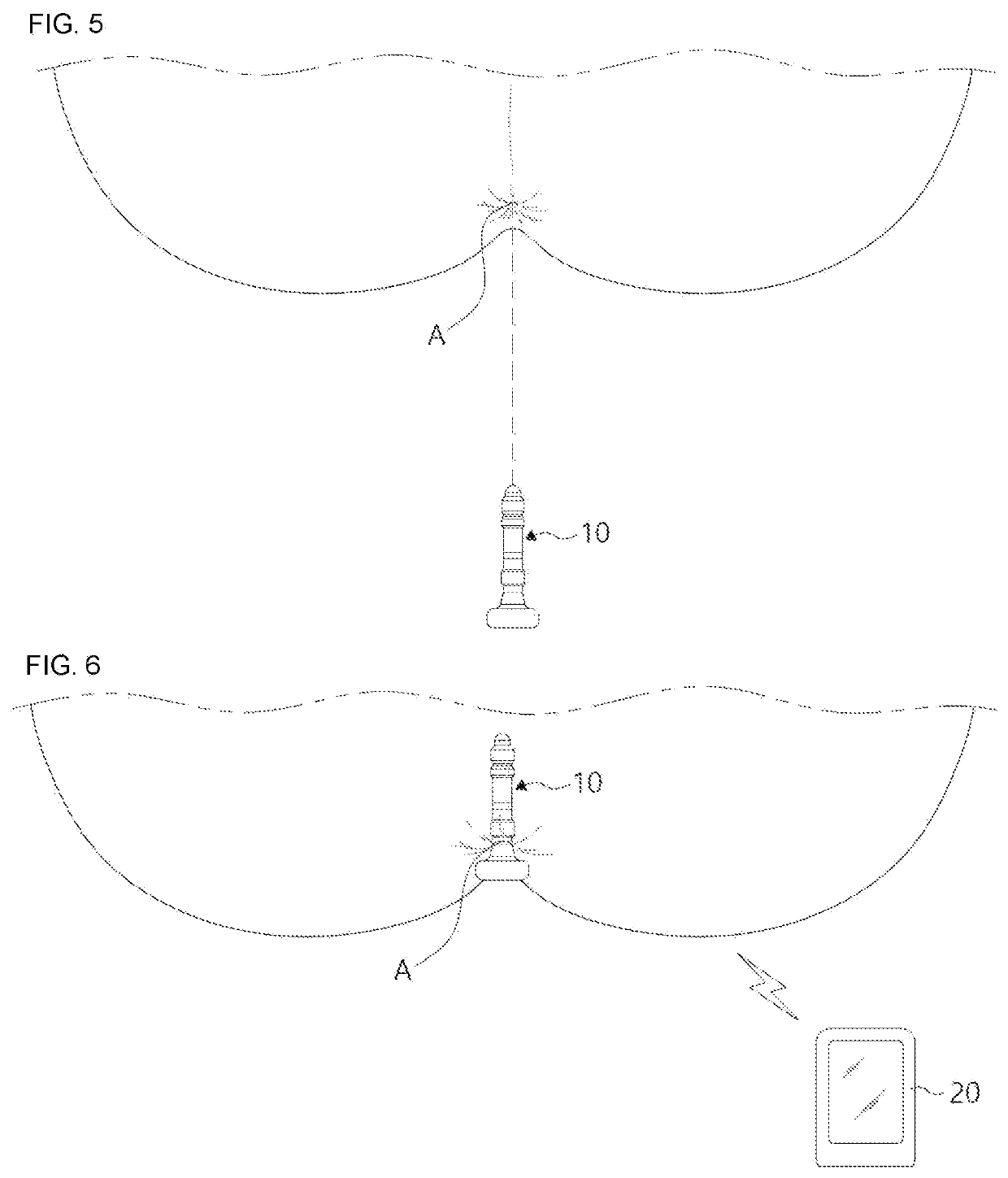 Prostate and hemorrhoid treatment device