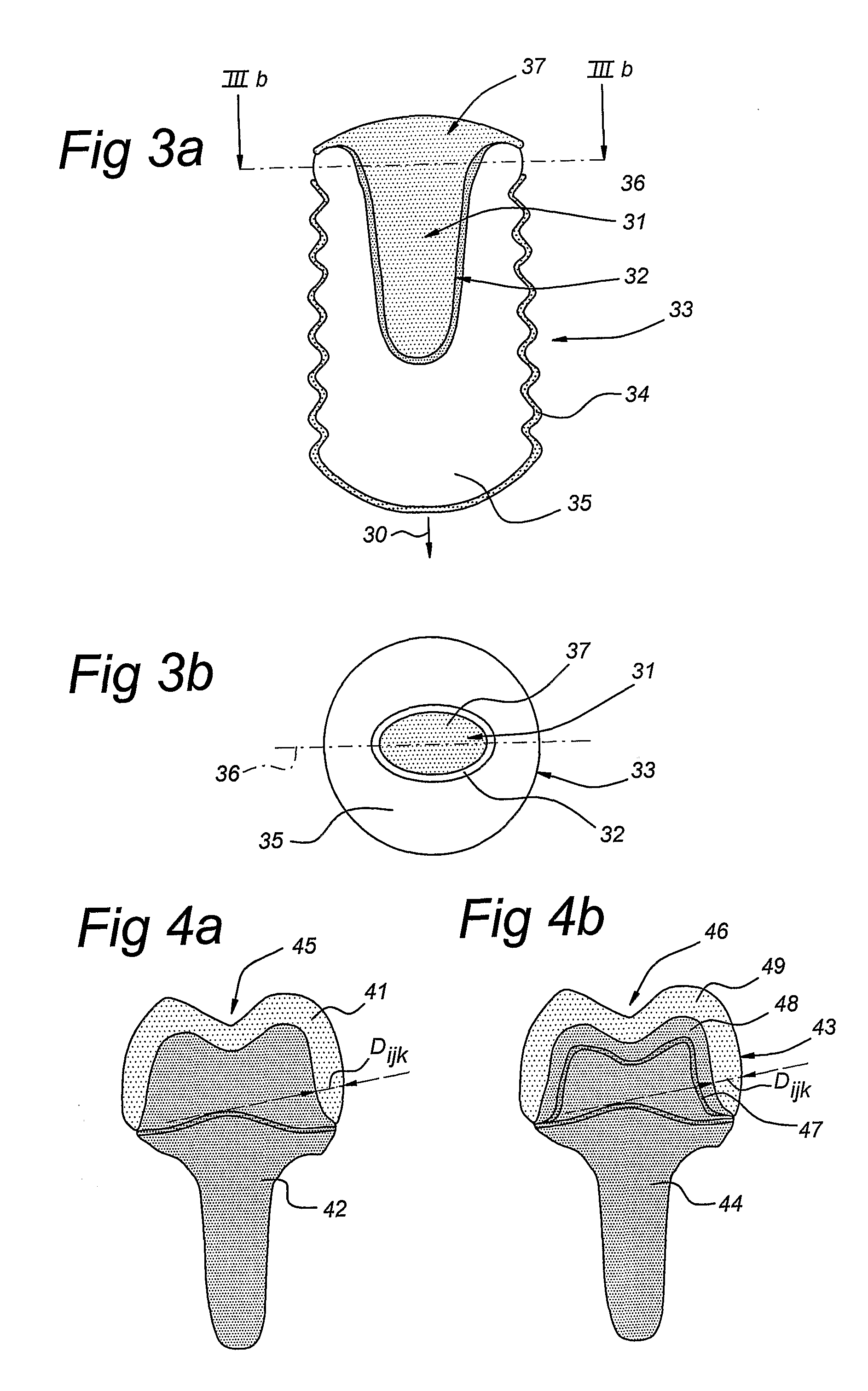 Method of Manufacturing and Installing a Ceramic Dental Implant with an Aesthetic Implant Abutment