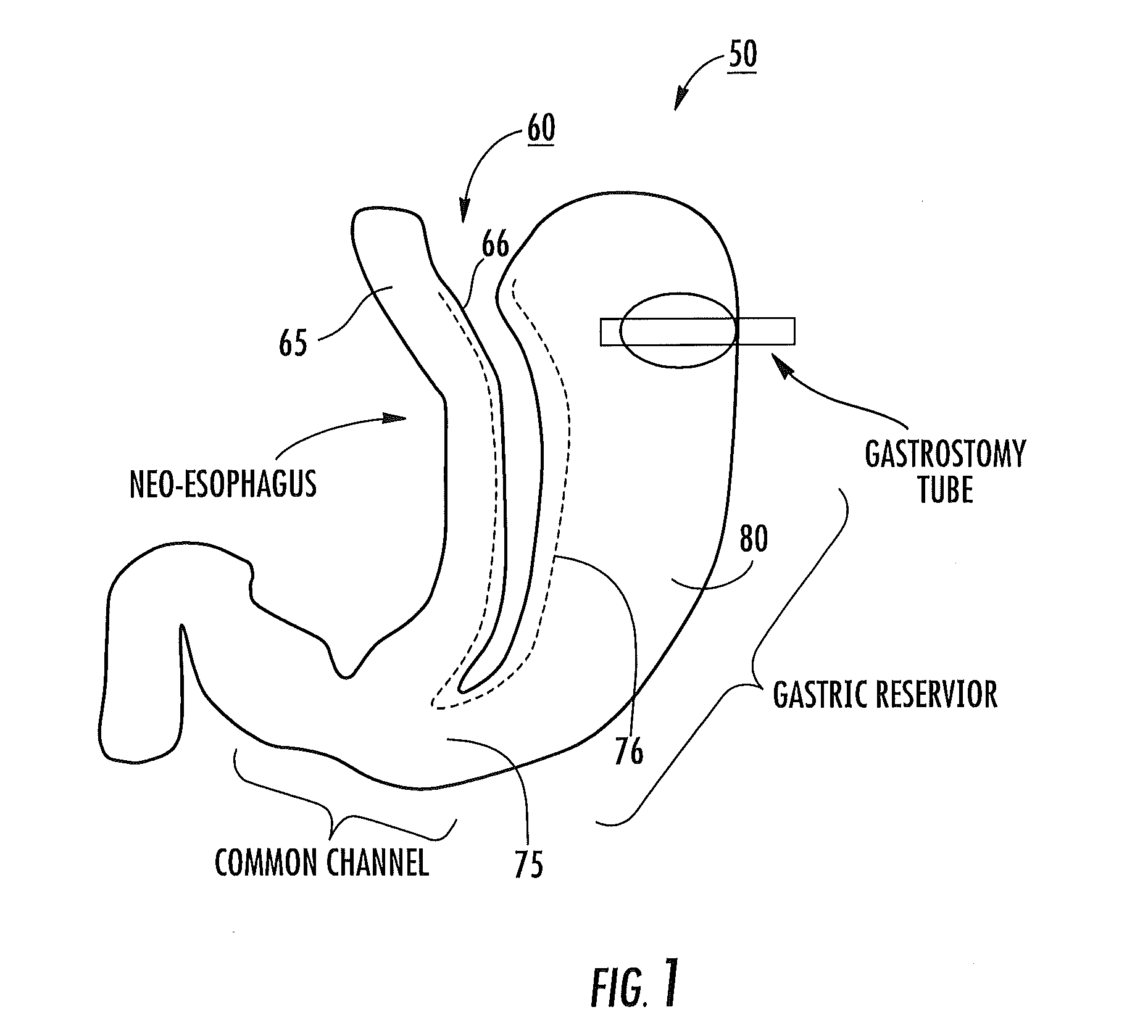 Surgical staplers with tissue protection and related methods
