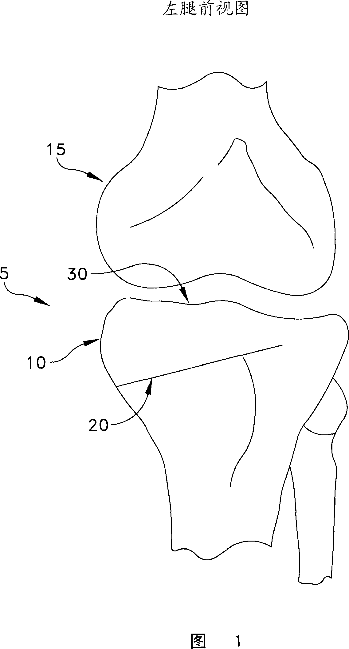 Apparatus for performing an open wedge, high tibial osteotomy