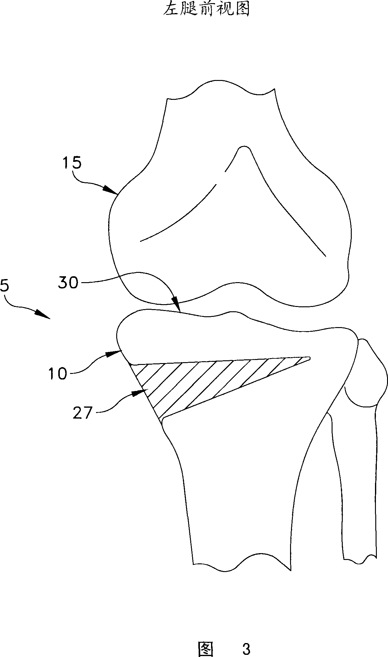 Apparatus for performing an open wedge, high tibial osteotomy