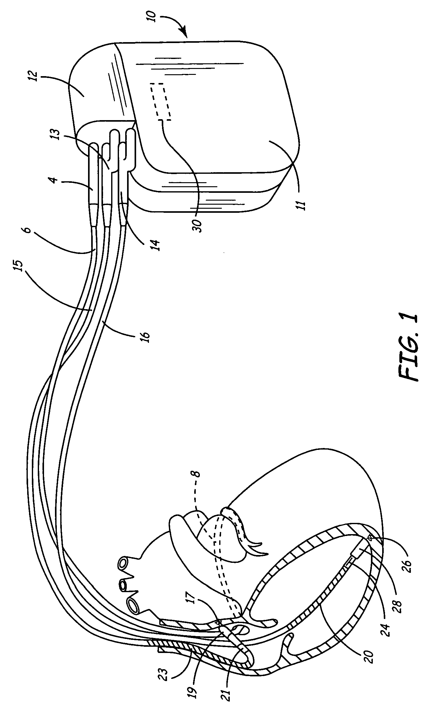 Method and apparatus for temporarily varying a parameter in an implantable medical device