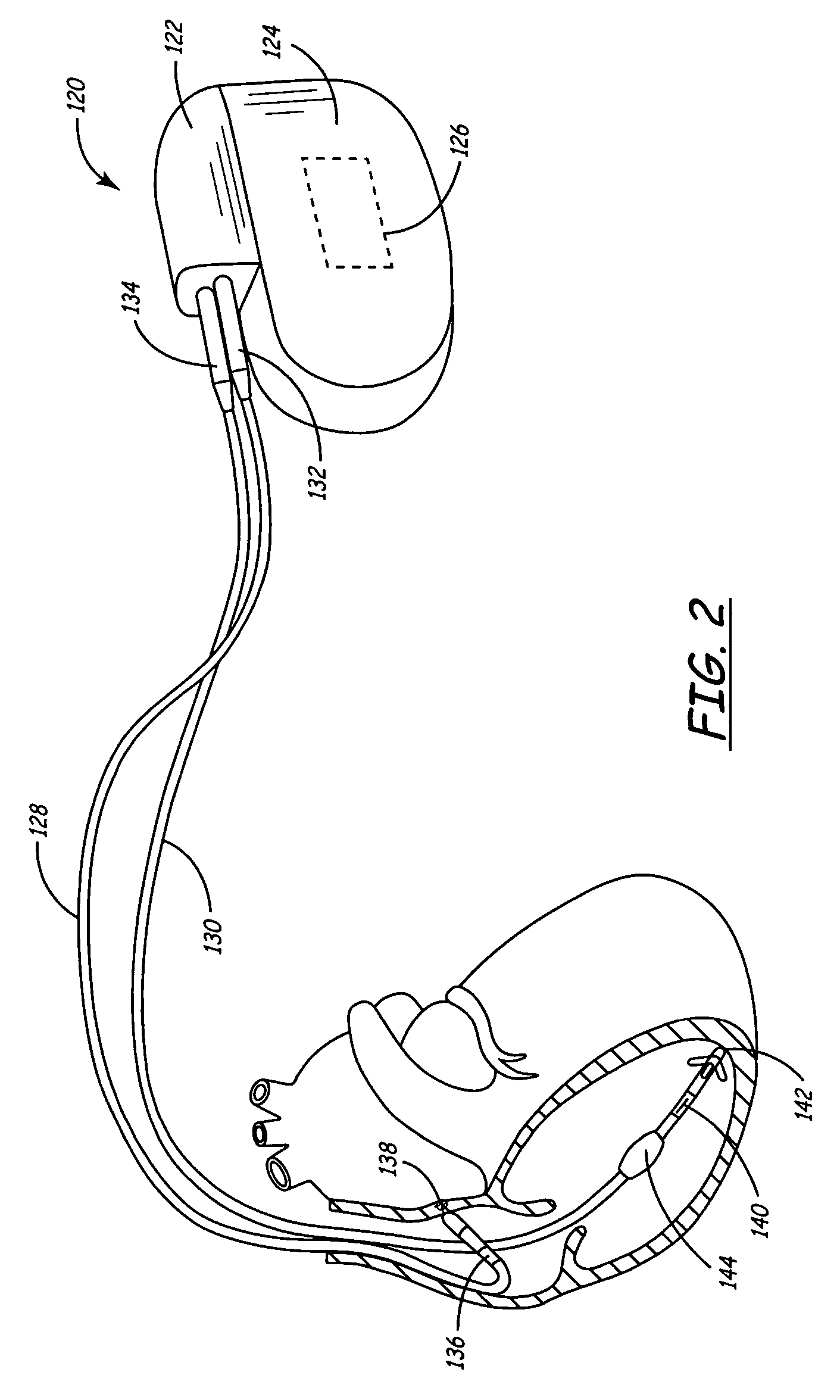 Method and apparatus for temporarily varying a parameter in an implantable medical device