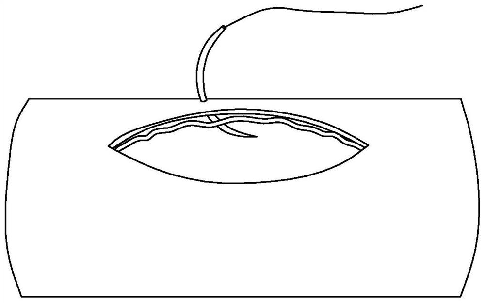 A blood vessel suturing device