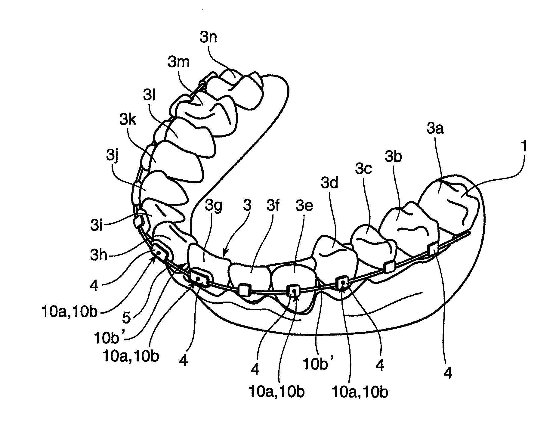 Orthodontic appliance