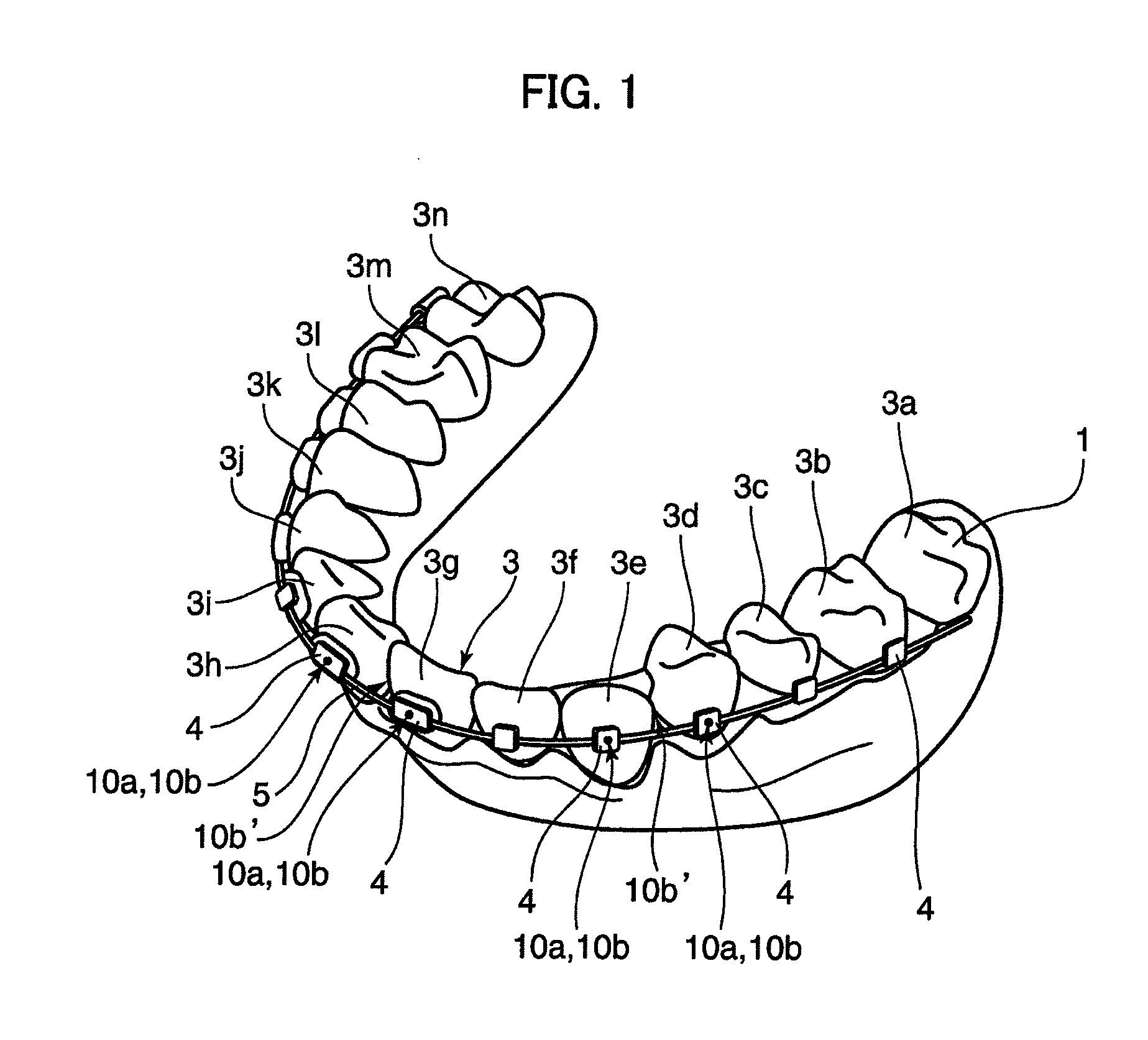 Orthodontic appliance