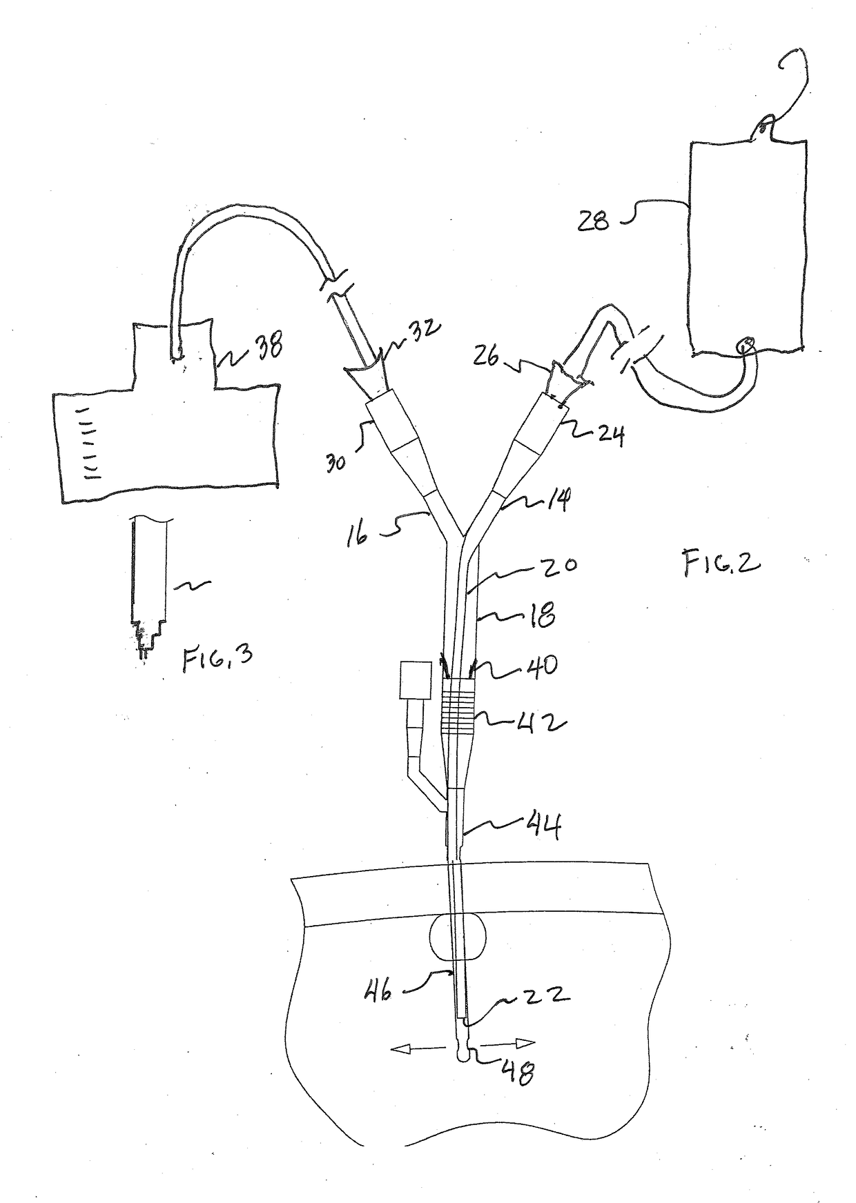 Continuous bladder irrigation adaptor for a foley catheter