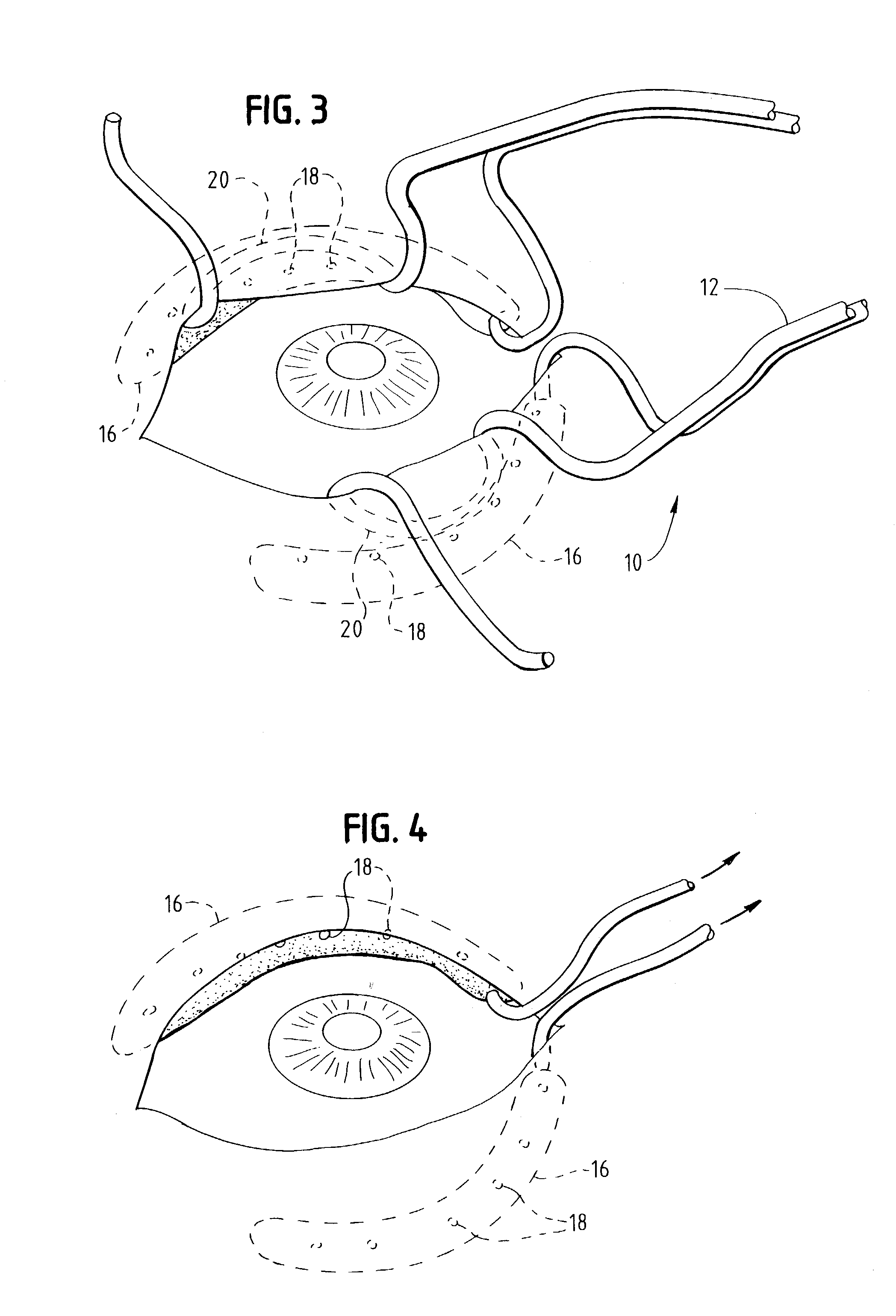 Ophthalmic sulcus speculum