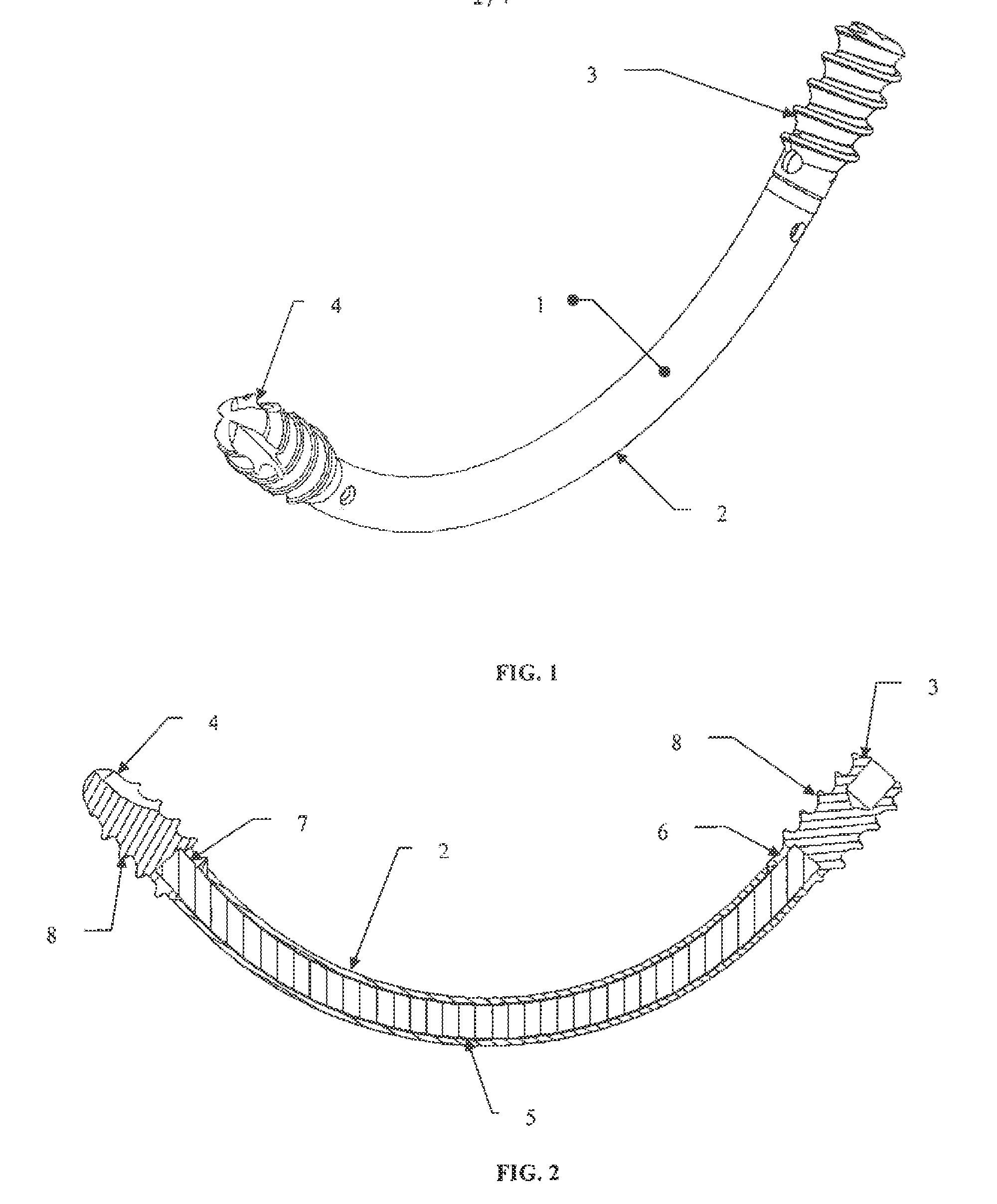 Curved assembly for reattachment of fragmented bone segments
