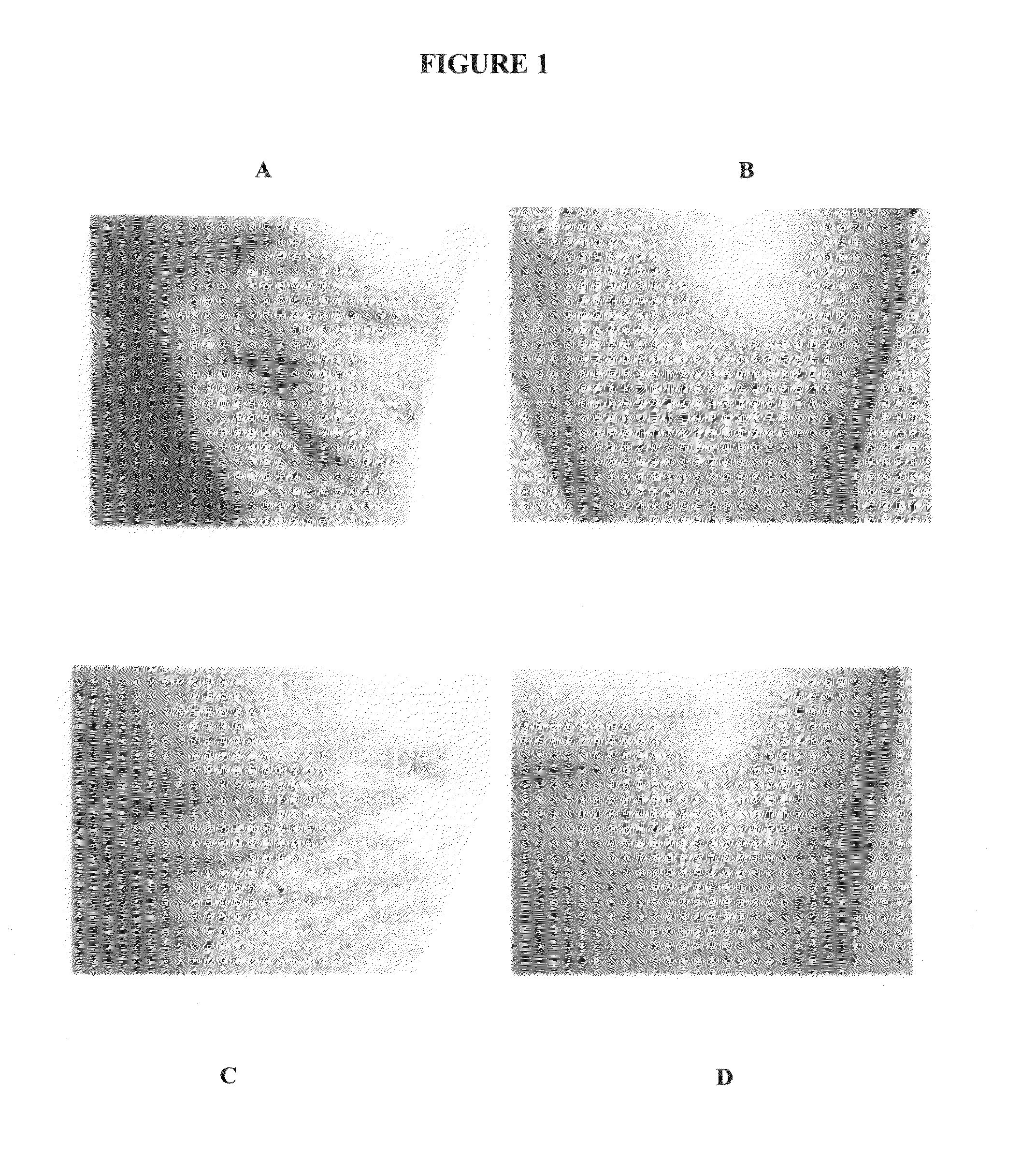 Pdt treatment method for cellulites and cosmetic use