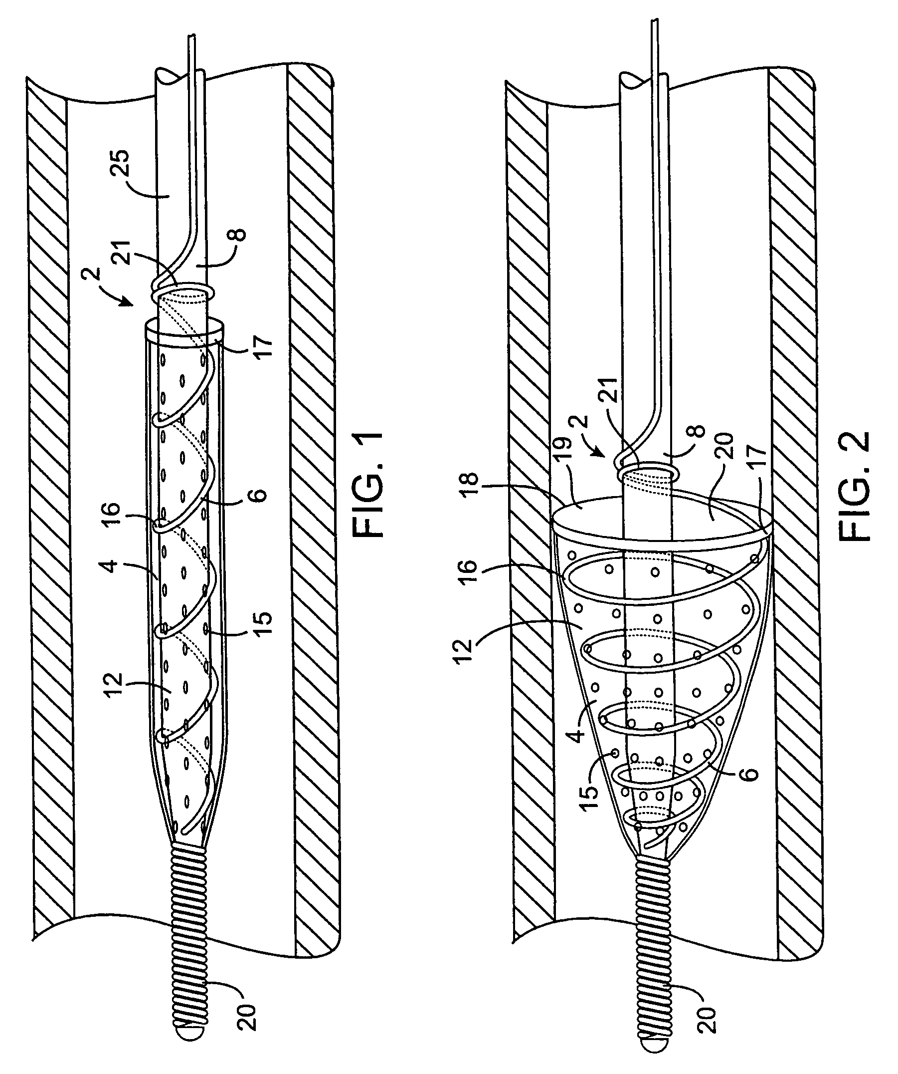 Methods and devices for filtering fluid flow through a body structure