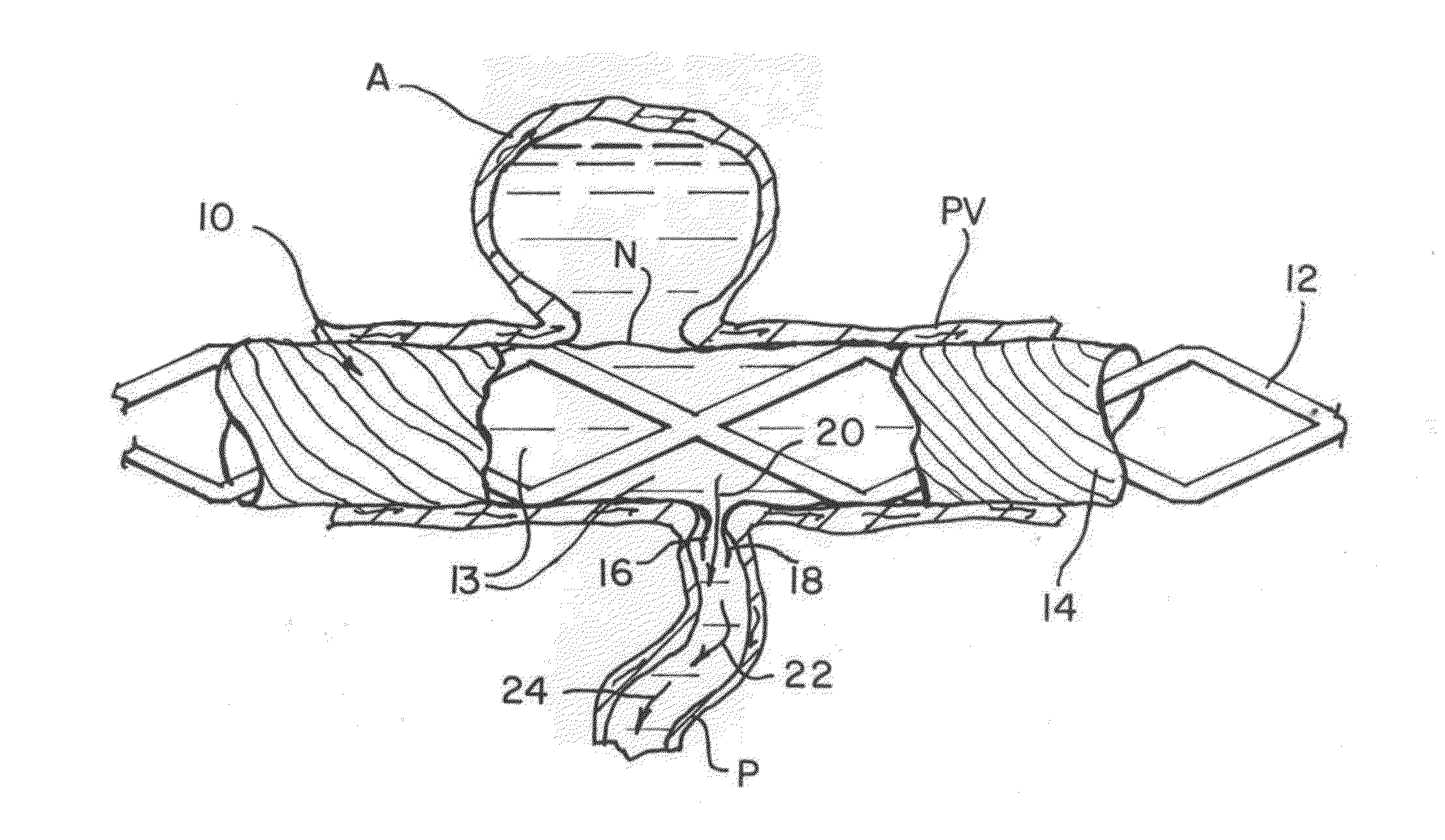 Method of fabricating modifiable occlusion device