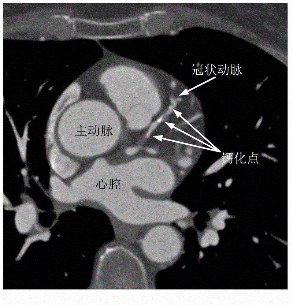 Coronary artery CT (computed tomography) contrastographic image calcification point detecting method