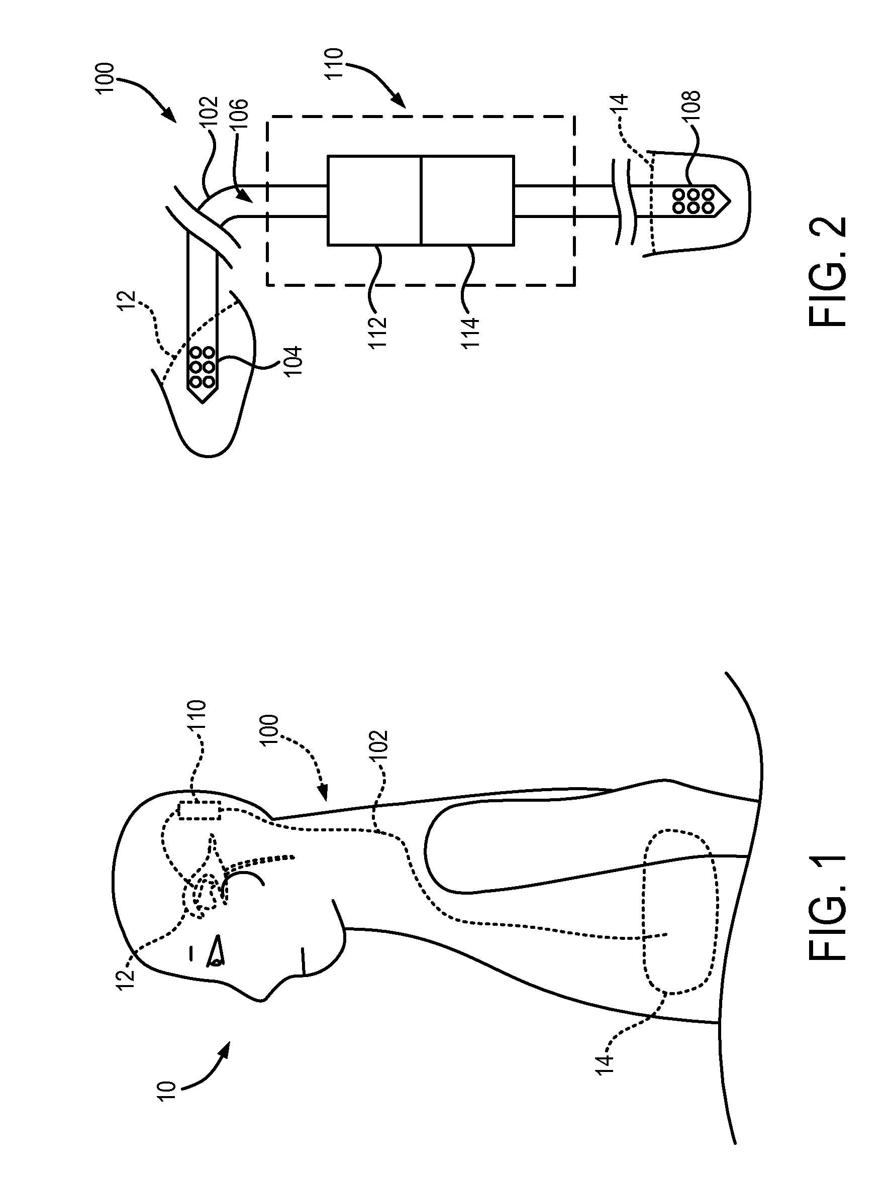 Systems and Methods for Controlling Cerebrospinal Fluid in a Subject's Ventricular System