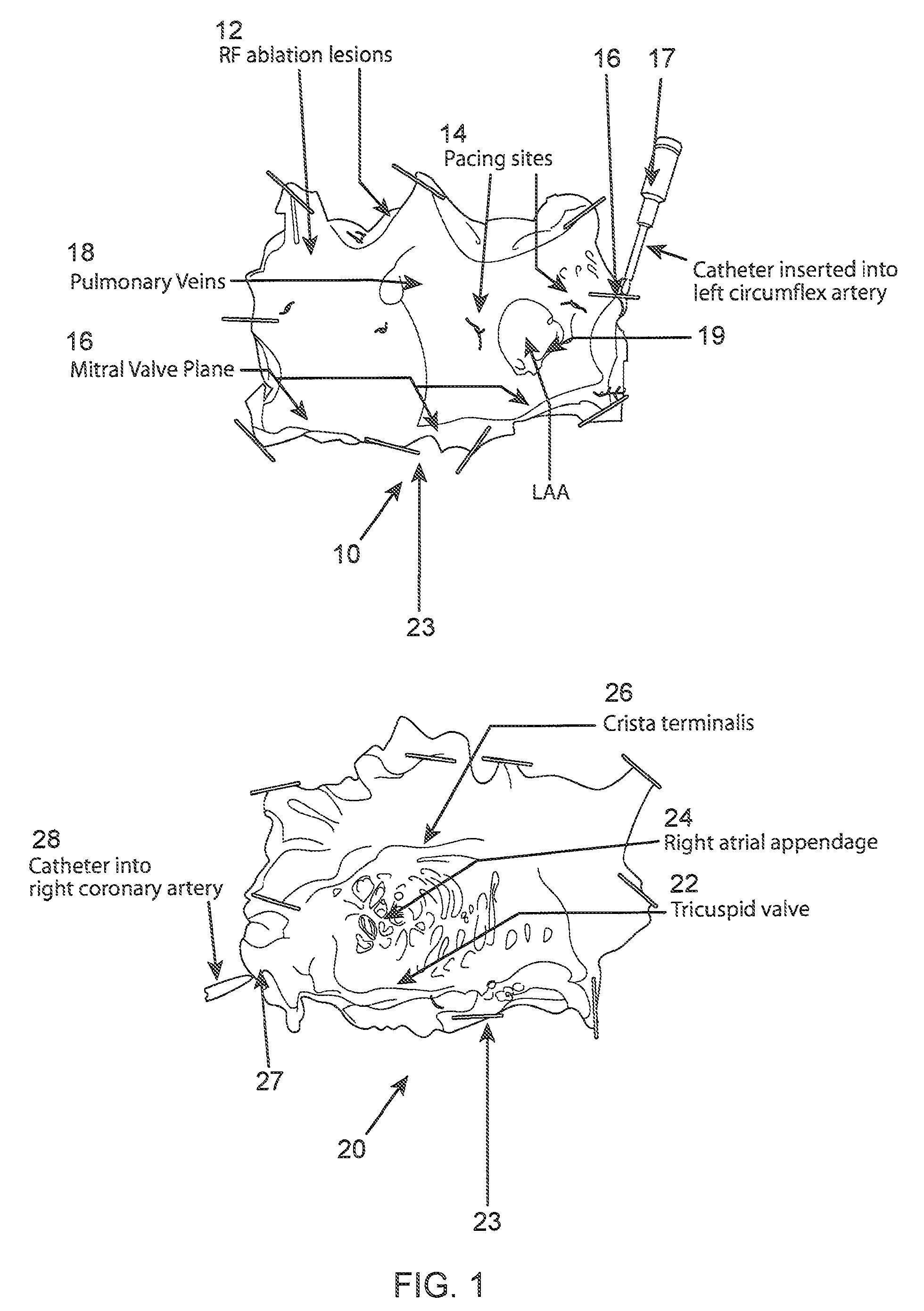 Method and associated system for the interventional treatment of atrial fibrillation