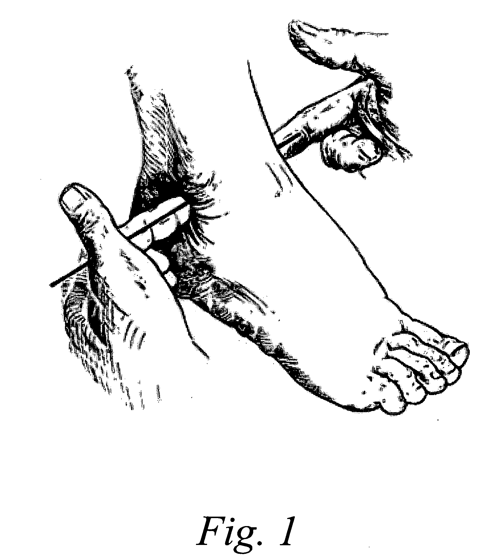 Ankle Derotation and Subtalar Stabilization Orthosis