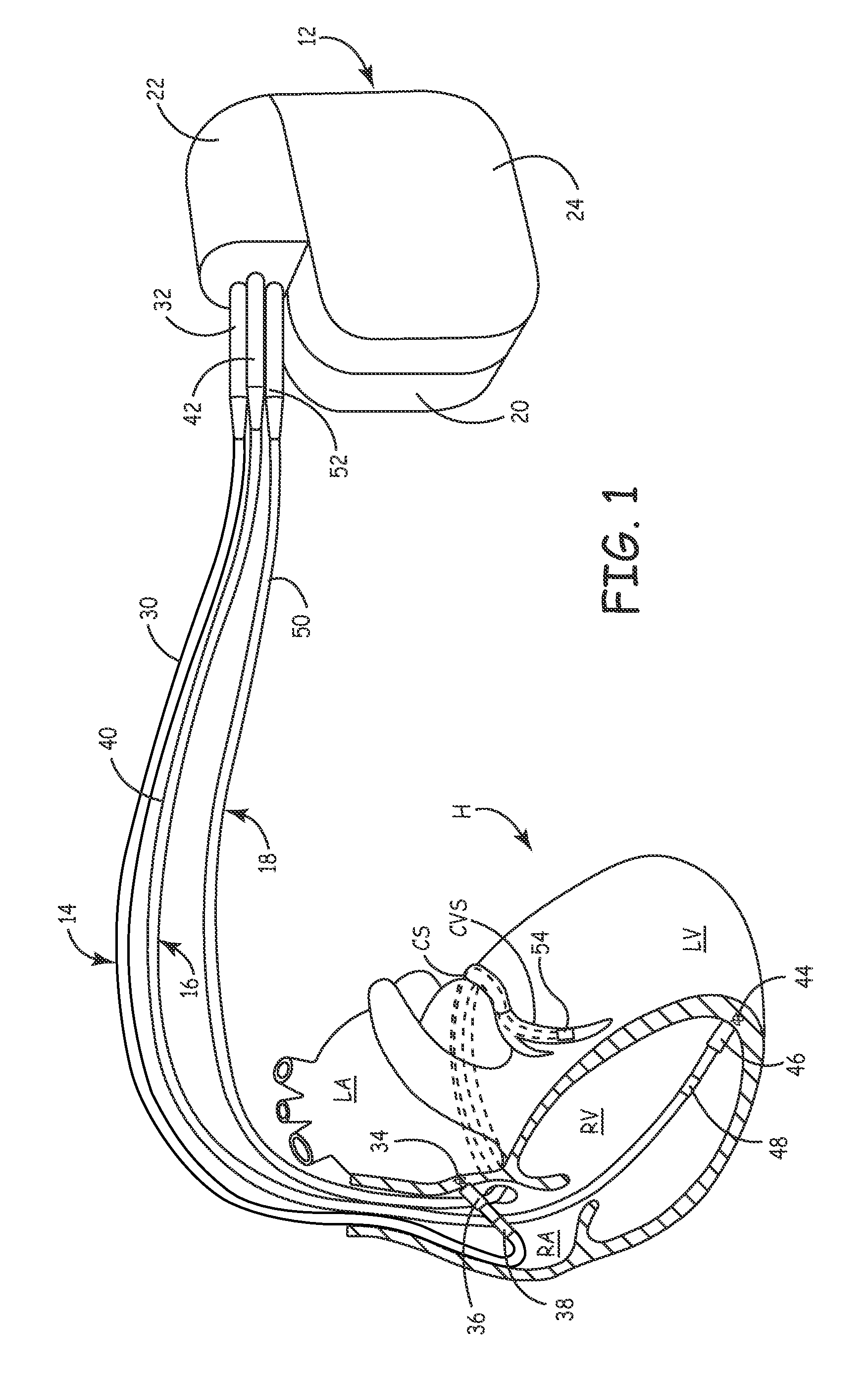 Method and apparatus for detecting left ventricular lead displacement based upon EGM change