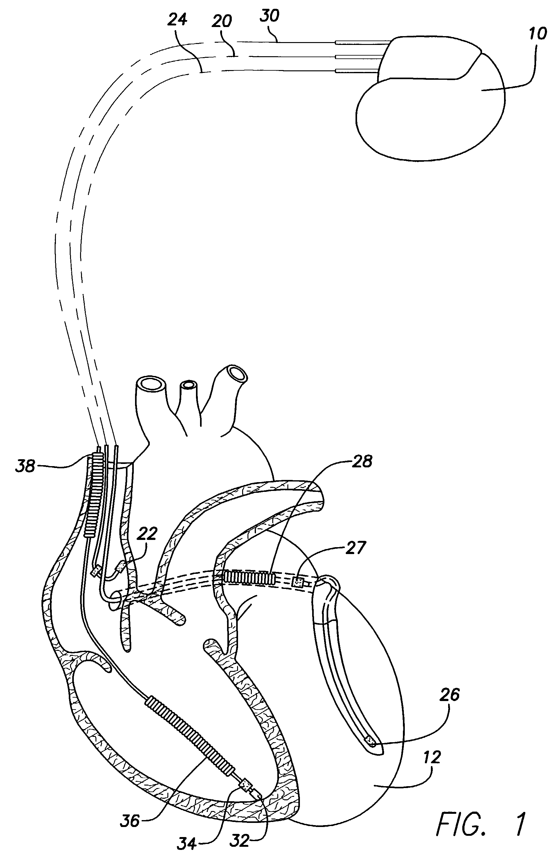 Implantable cardiac device having a system for detecting T wave alternan patterns and method