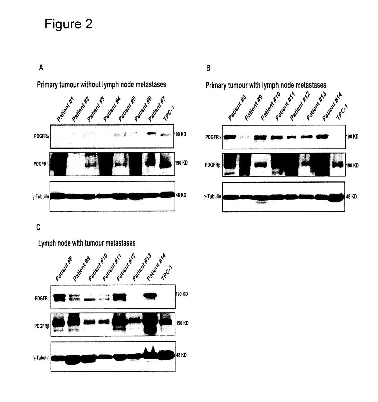 Methods, kits, and systems for treatment of metastatic papillary thyroid cancer