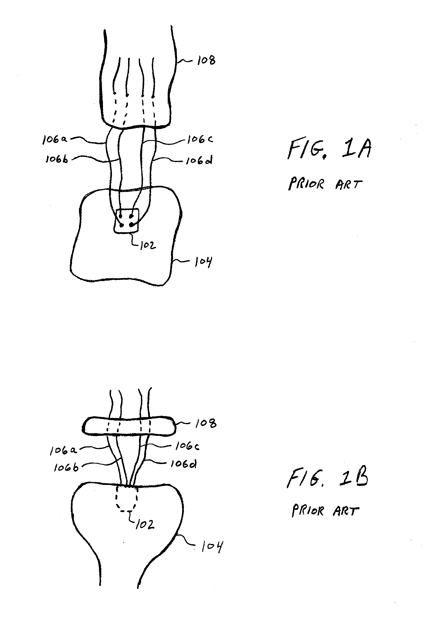 Soft Tissue Fixation Using A Looped Suture Construct