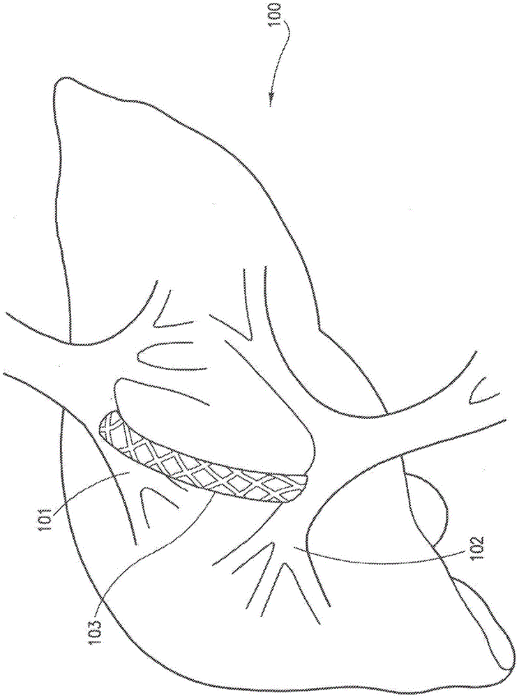 Transjugular intrahepatic portosystemic shunt device