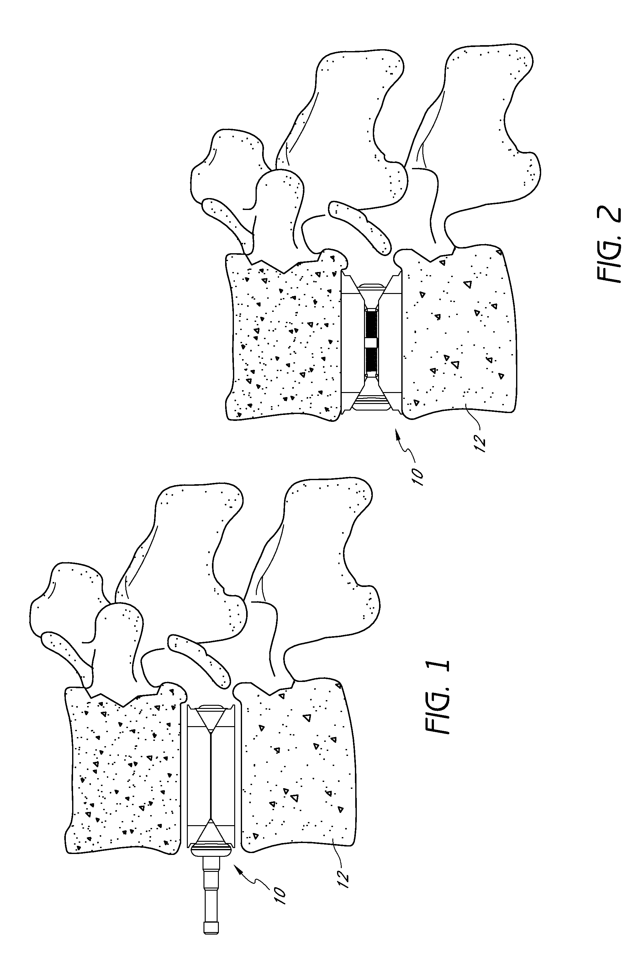 Intervertebral implant