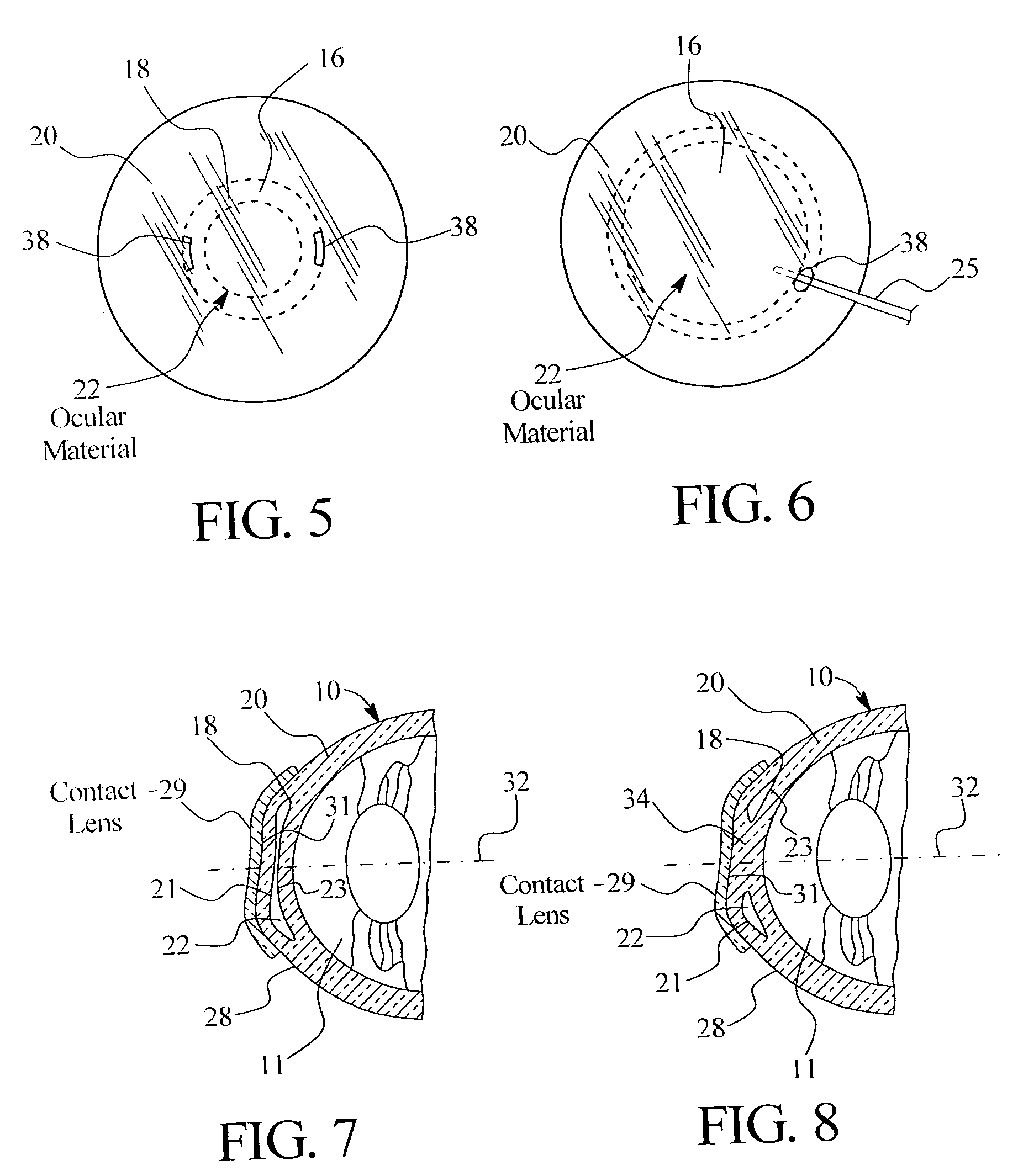Method of treatment of refractive errors using subepithelial or intrastromal corneal inlay with bonding coating
