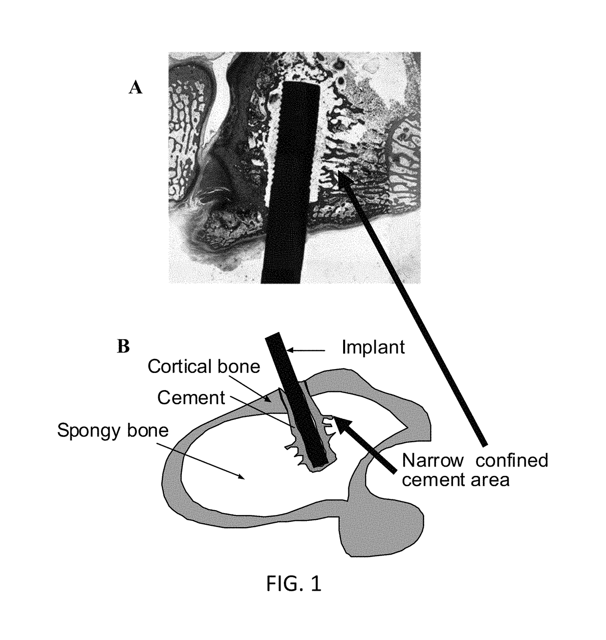 Method and apparatus to control the heterogeneous flow of bone cement and improve osseointegration of cemented implant