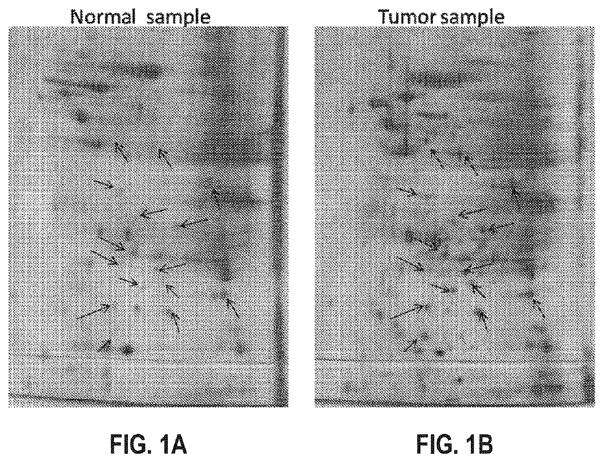 Specific biomarker set for non-invasive diagnosis of liver cancer