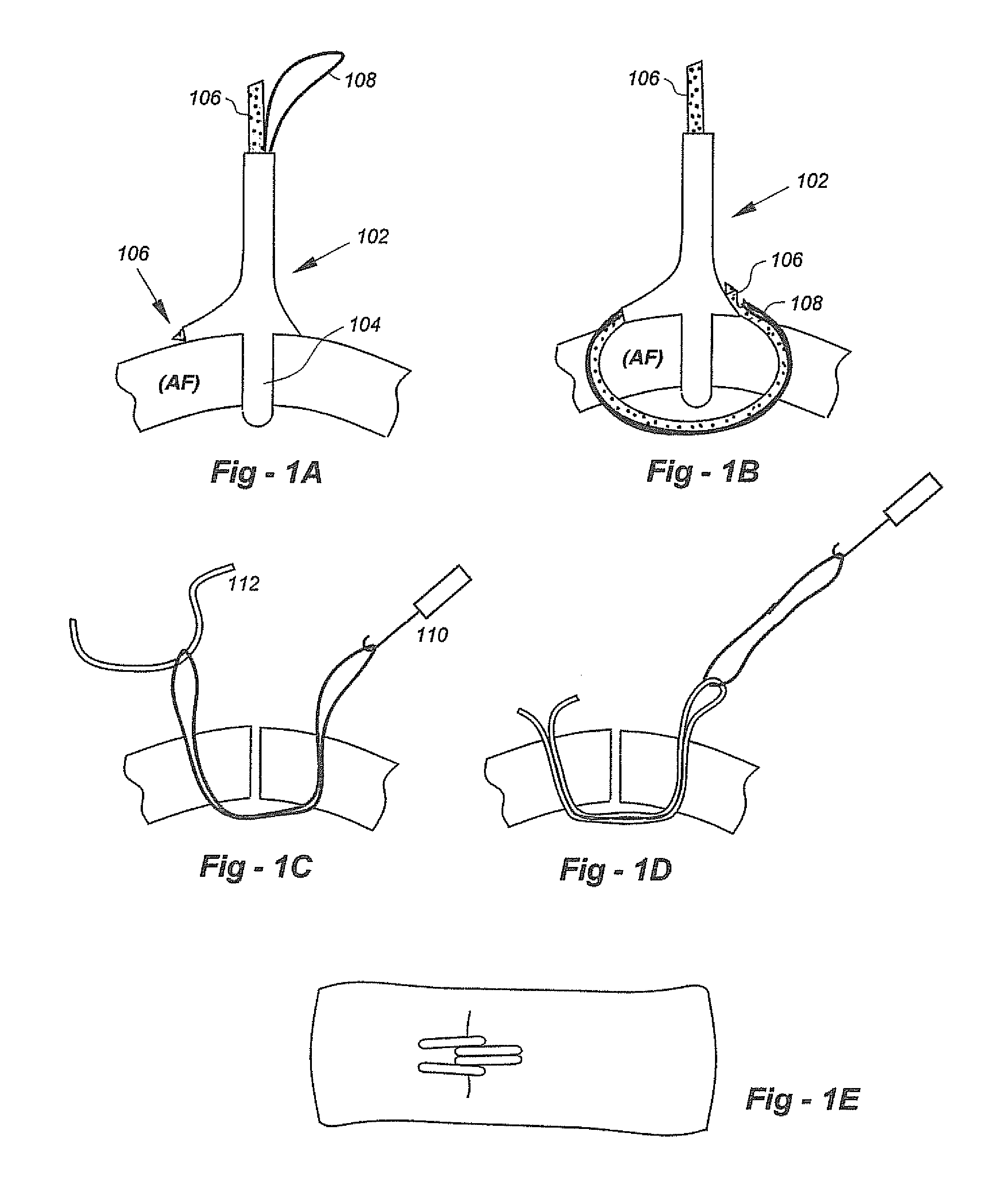 Soft tissue repair methods and apparatus