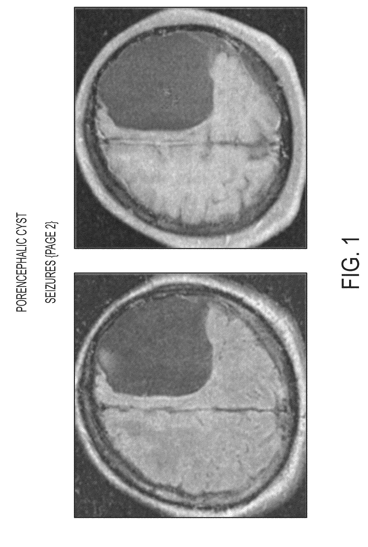 Method for intrathecal administration of autologous stem cells in premature infants