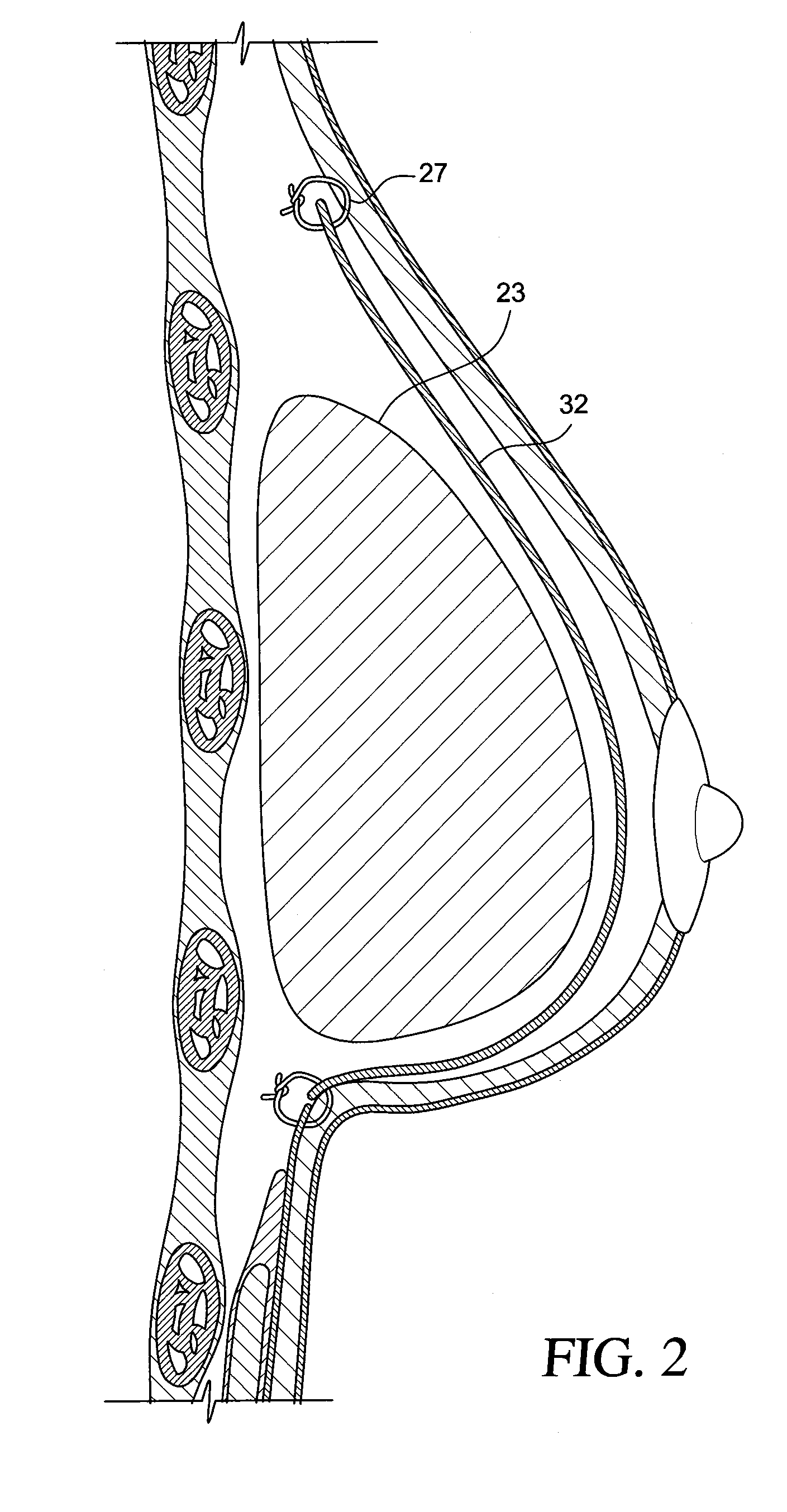 Method for texturing the surface of a synthetic implant