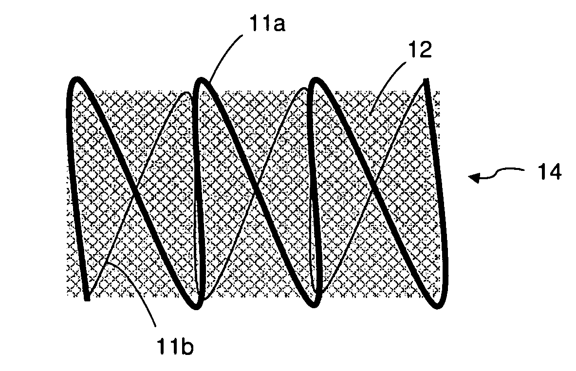 Minimally-Invasive Method and Device for Permanently Compressing Tissues within the Body