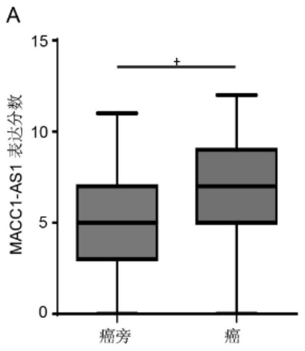 Application of macc1-as1 probe in preparation of diagnostic reagents for predicting clinical prognosis of gastric cancer