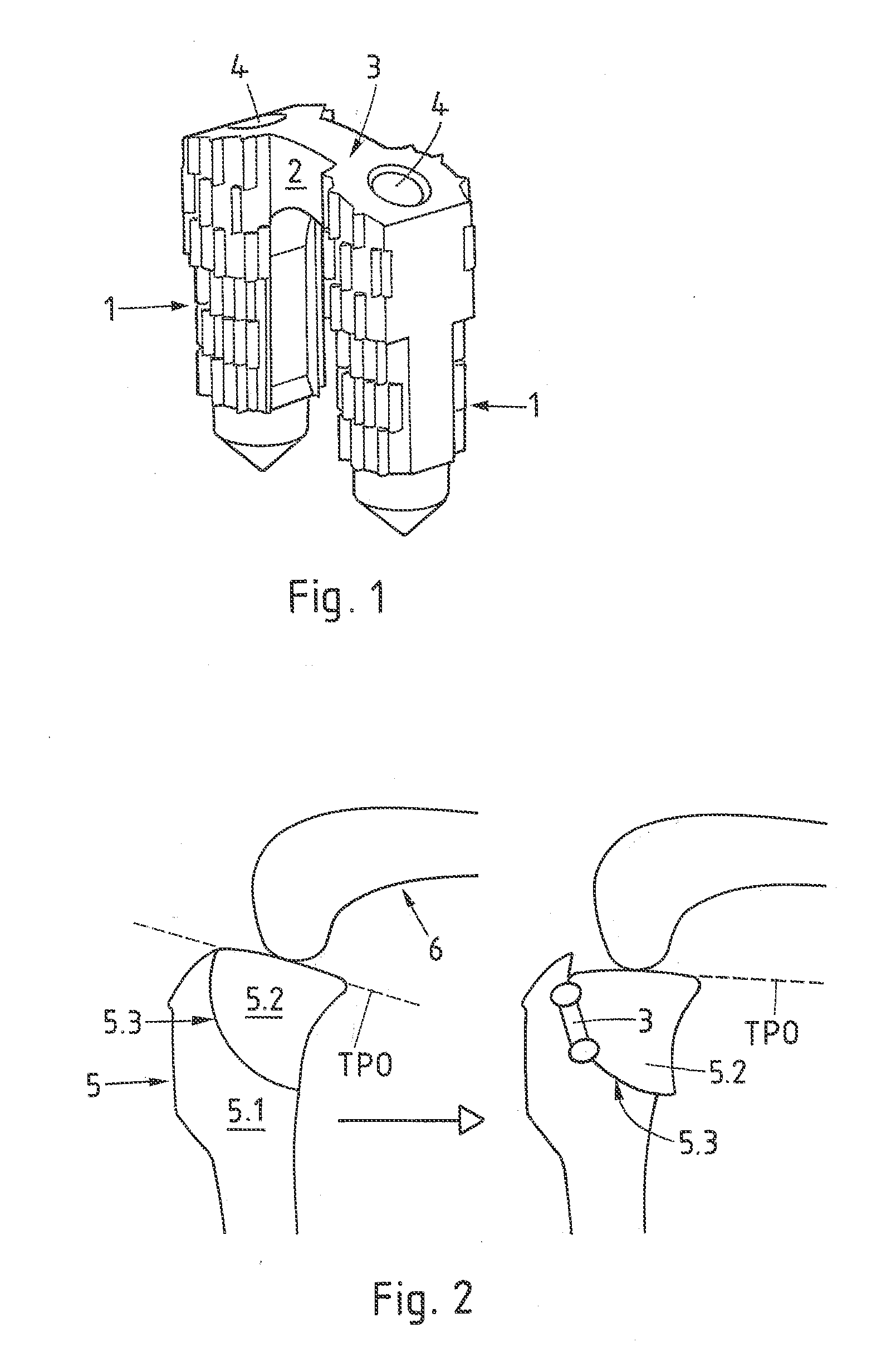 Method and implant for stabilizing two bone portions separated by a cut or fracture