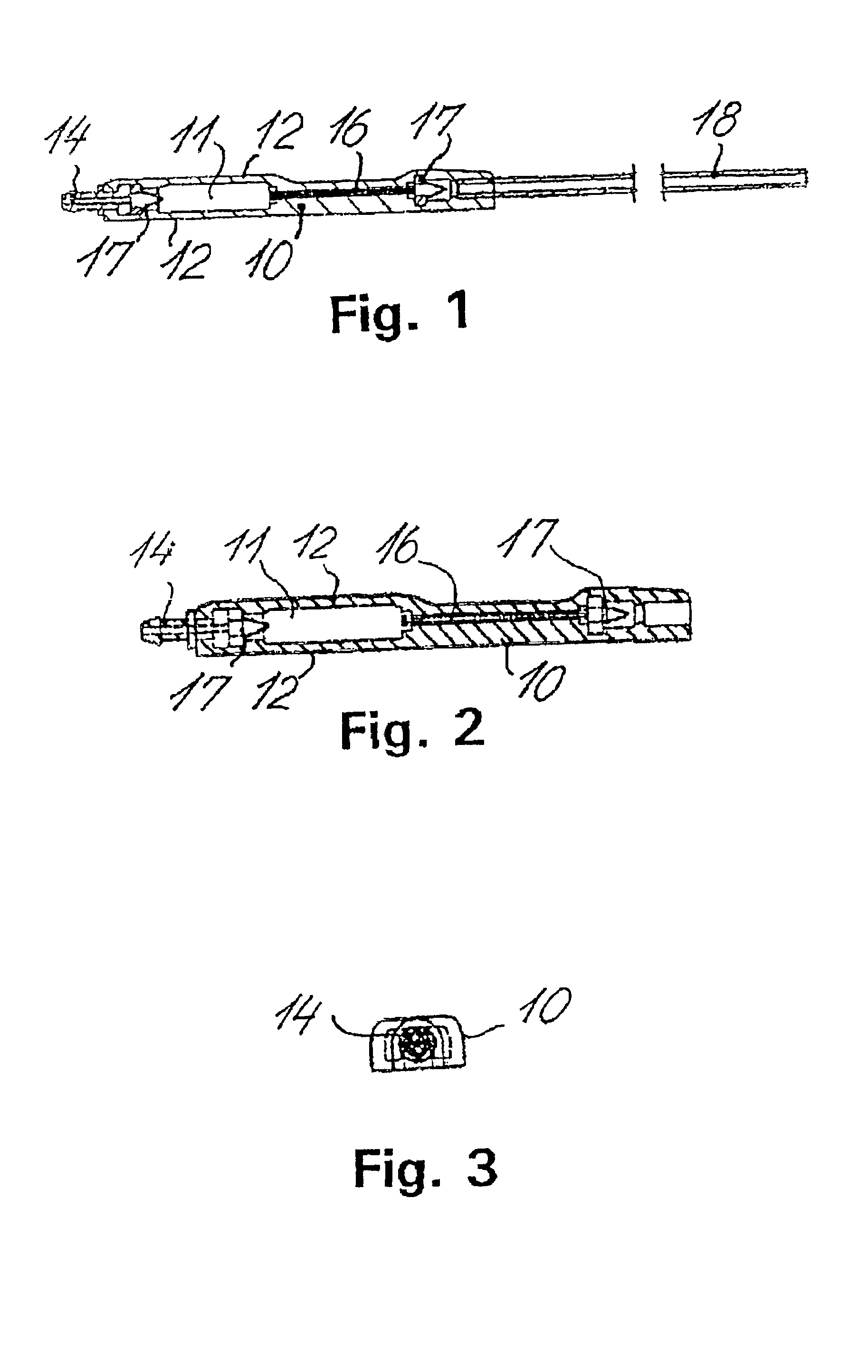 Fluid shunt system and a method for the treatment of hydrocephalus