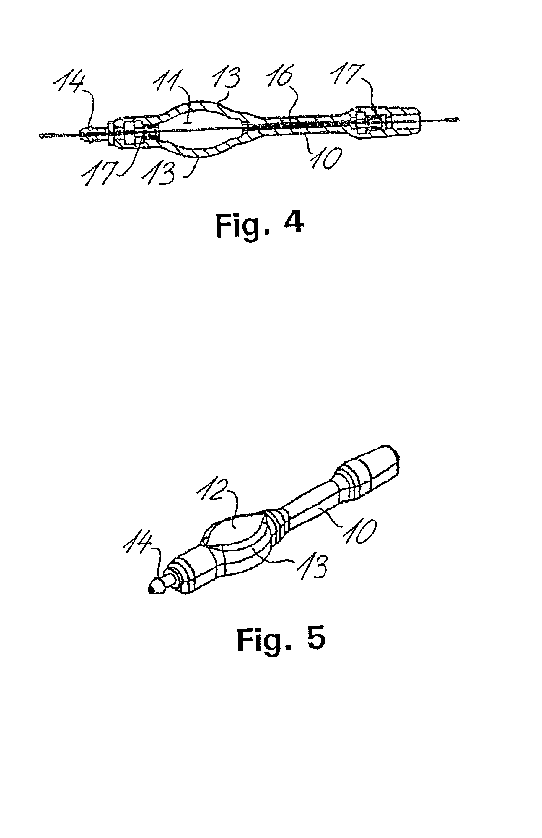 Fluid shunt system and a method for the treatment of hydrocephalus