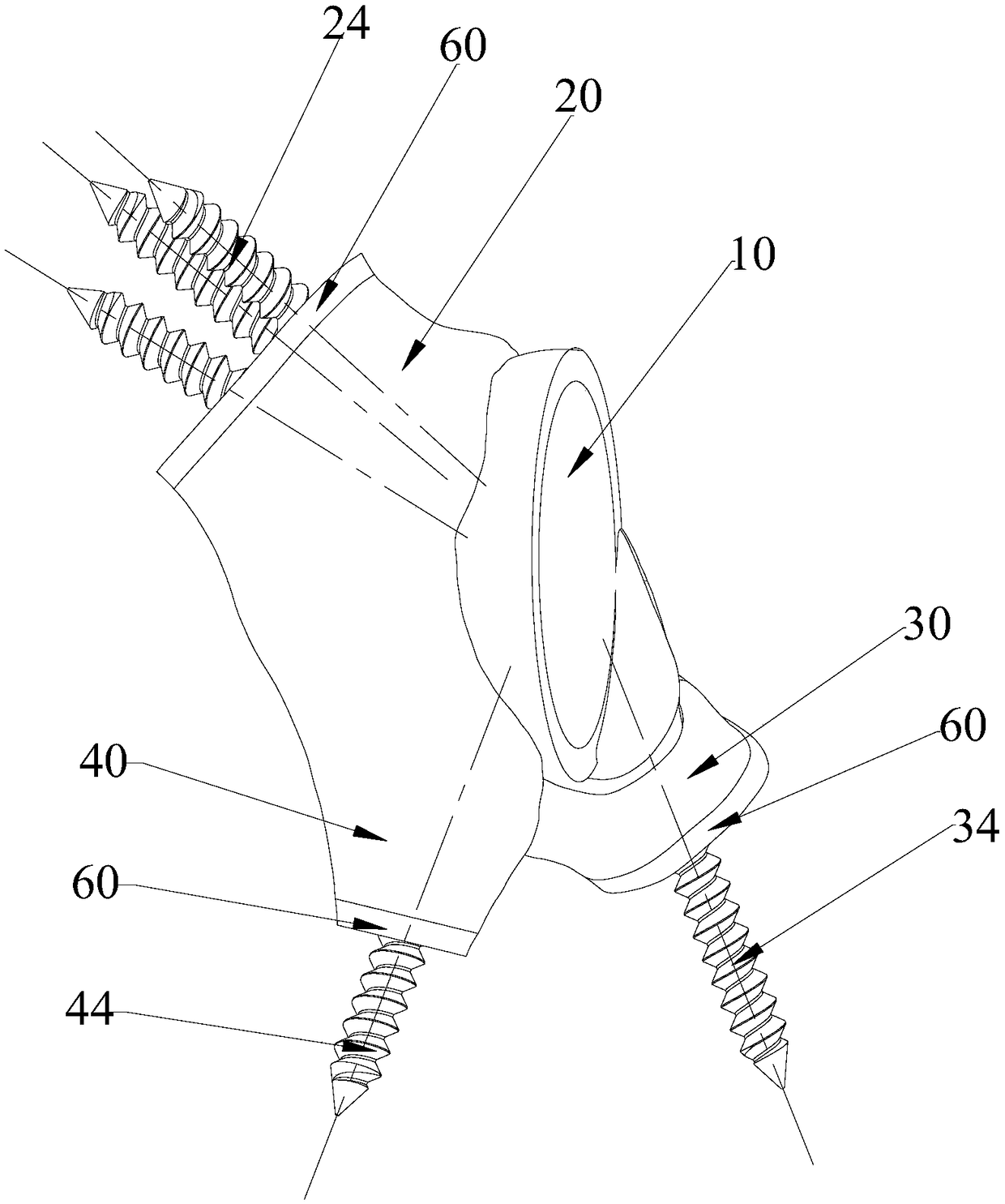 Prosthetic structures around the acetabulum