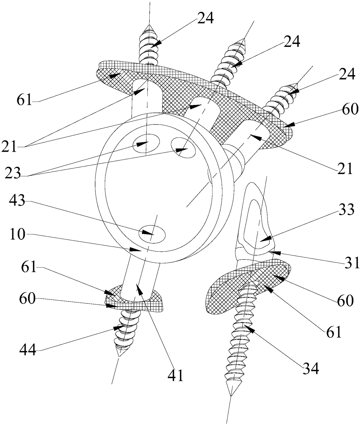 Prosthetic structures around the acetabulum