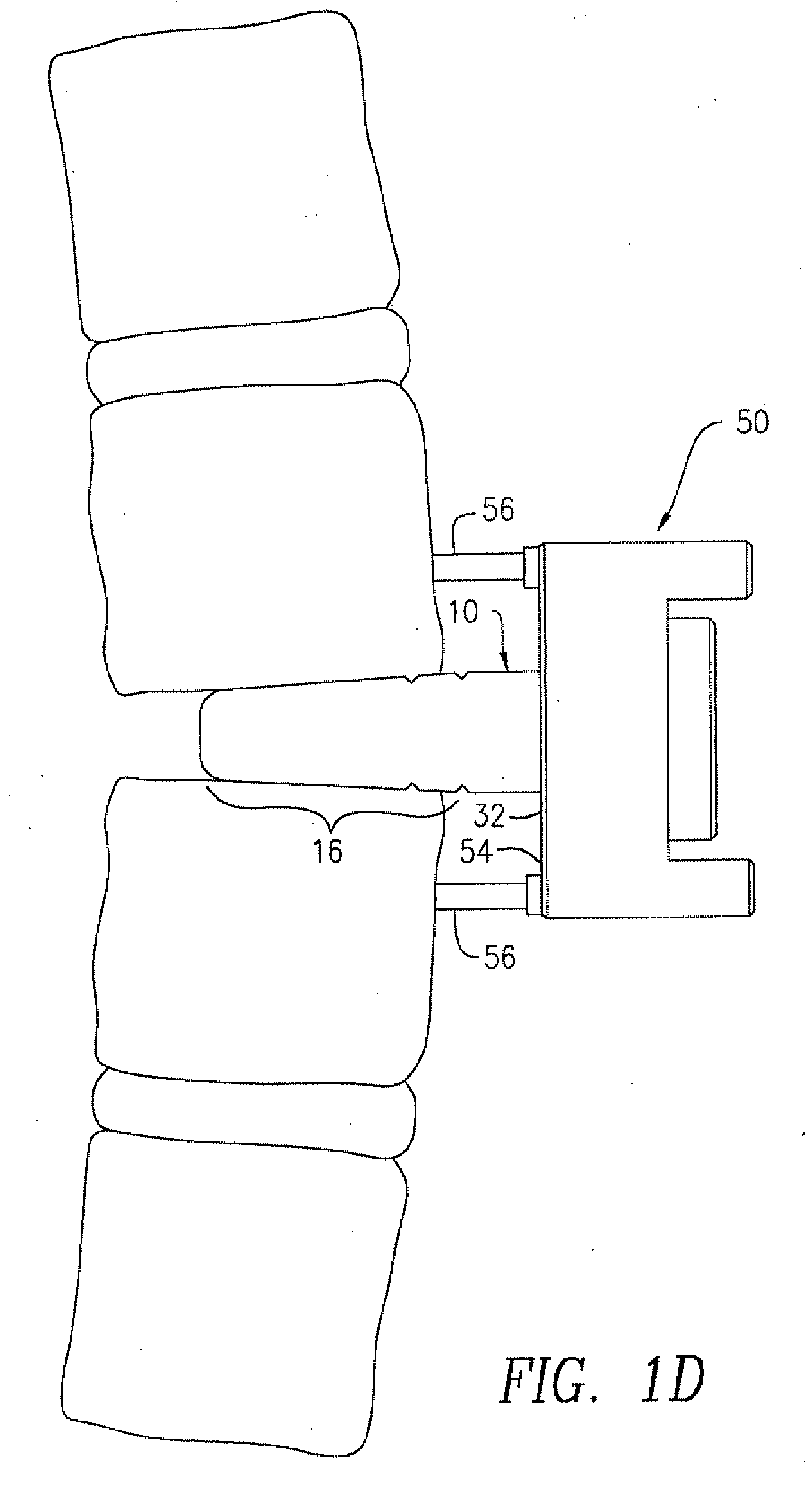 Instrument system for preparing a disc space between adjacent vertebral bodies to receive a repair device